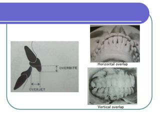 CLASSIFICATION OF MALOCCLUSION.ppt