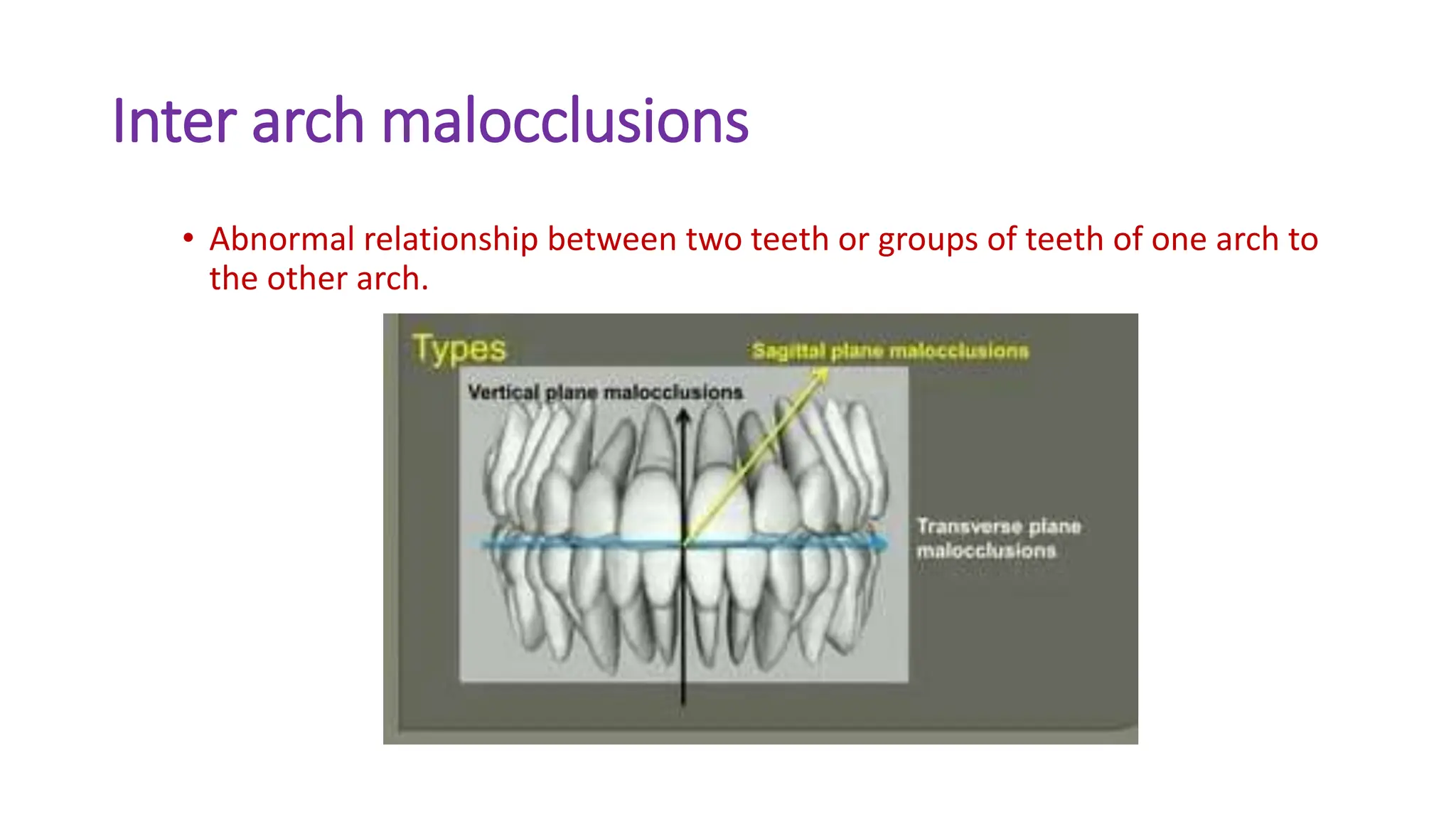 Inter arch malocclusions
• Abnormal relationship between two teeth or groups of teeth of one arch to
the other arch.
 