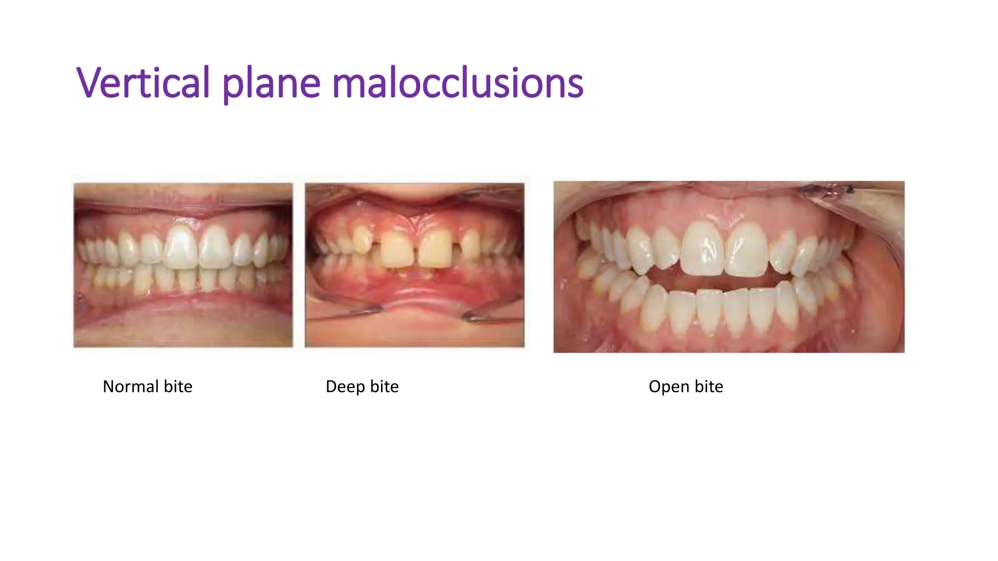 Vertical plane malocclusions
Normal bite Deep bite Open bite
 