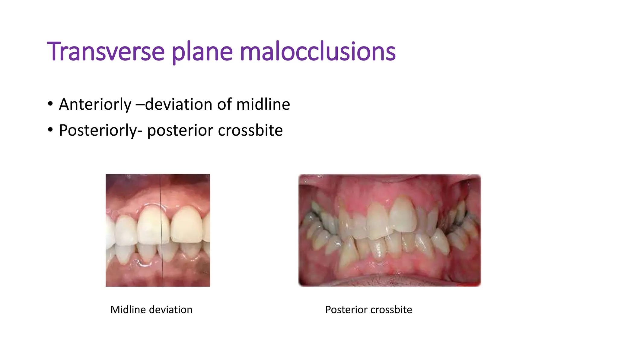 Transverse plane malocclusions
• Anteriorly –deviation of midline
• Posteriorly- posterior crossbite
Midline deviation Posterior crossbite
 