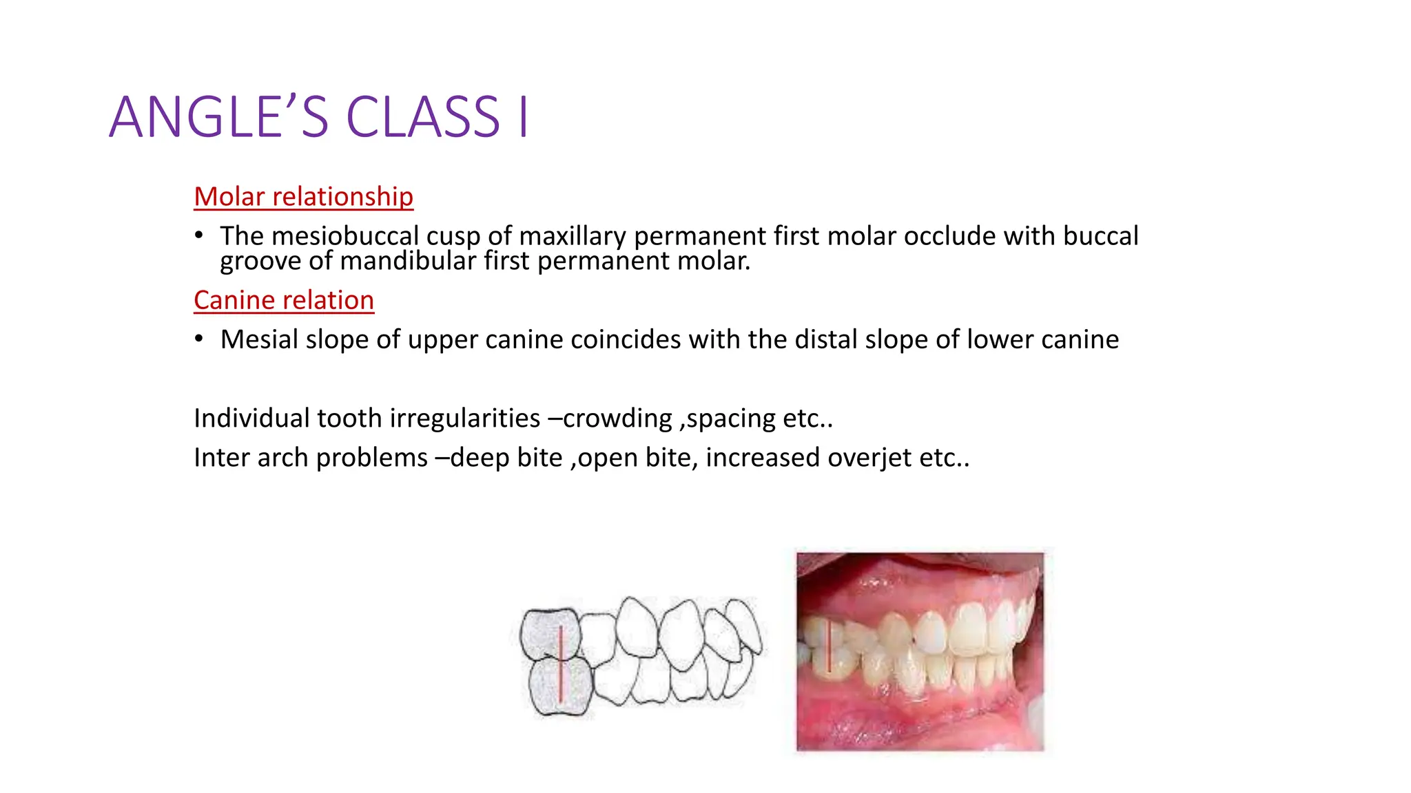 ANGLE’S CLASS I
Molar relationship
• The mesiobuccal cusp of maxillary permanent first molar occlude with buccal
groove of mandibular first permanent molar.
Canine relation
• Mesial slope of upper canine coincides with the distal slope of lower canine
Individual tooth irregularities –crowding ,spacing etc..
Inter arch problems –deep bite ,open bite, increased overjet etc..
 
