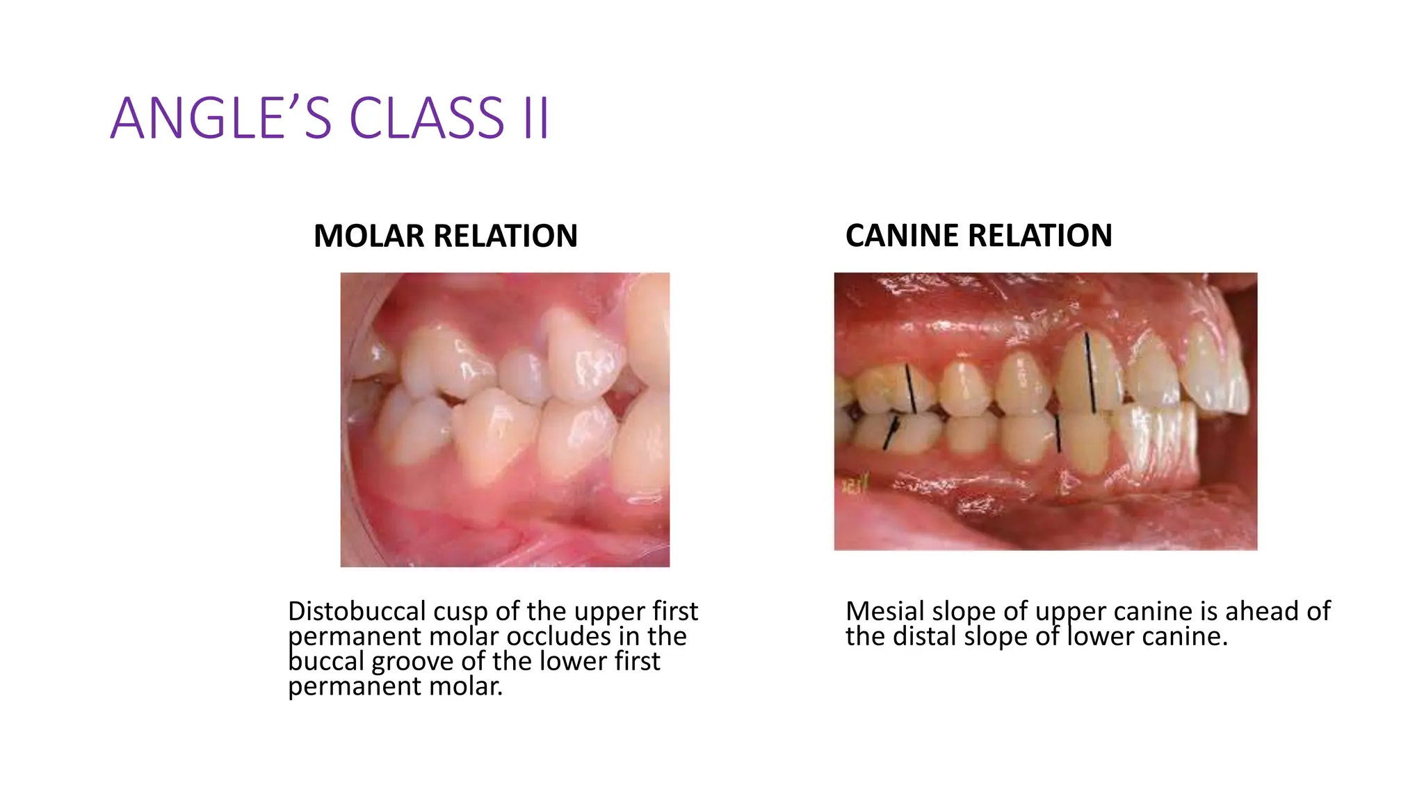 ANGLE’S CLASS II
MOLAR RELATION
Distobuccal cusp of the upper first
permanent molar occludes in the
buccal groove of the lower first
permanent molar.
CANINE RELATION
Mesial slope of upper canine is ahead of
the distal slope of lower canine.
 