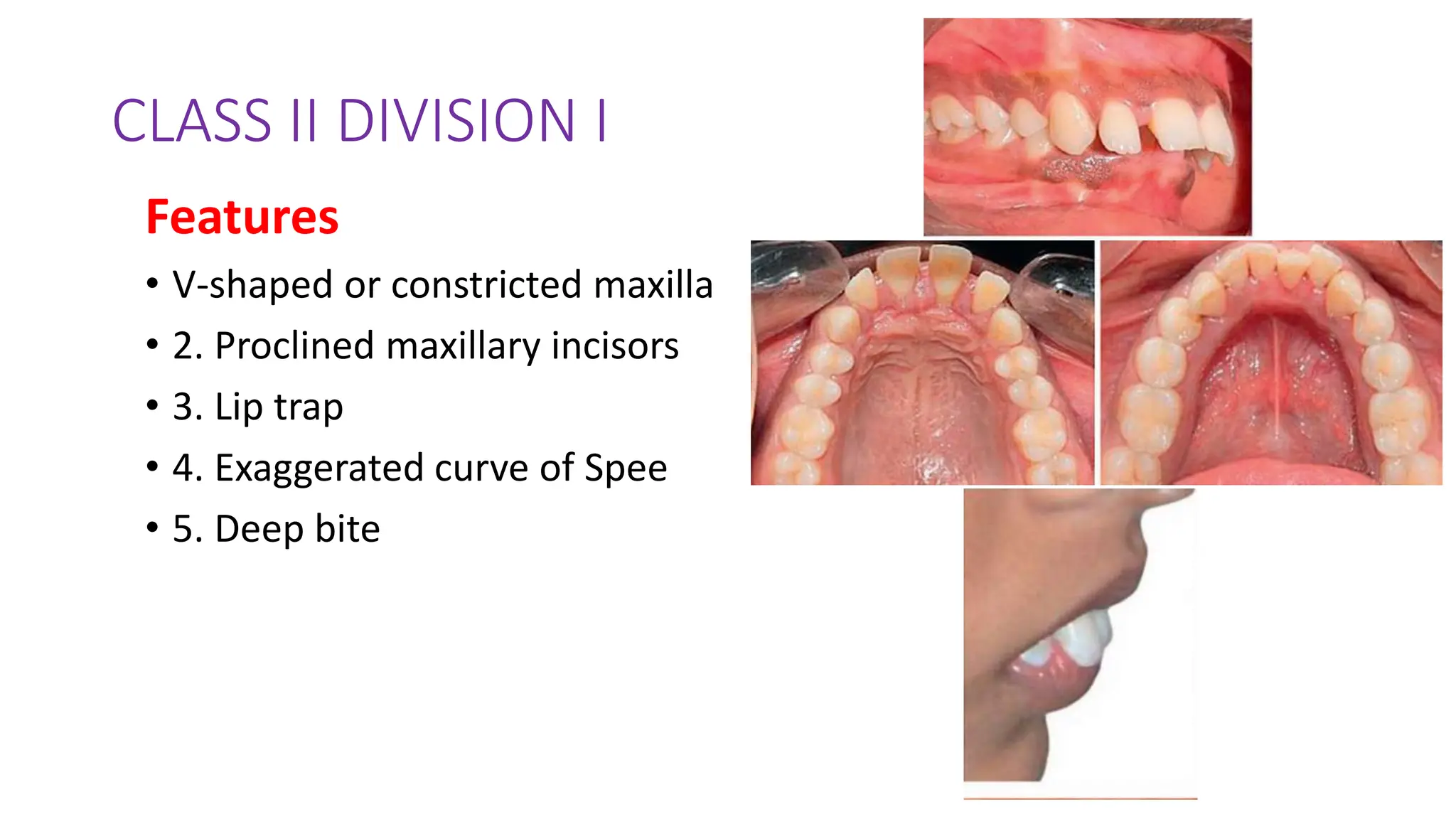 CLASS II DIVISION I
Features
• V-shaped or constricted maxilla
• 2. Proclined maxillary incisors
• 3. Lip trap
• 4. Exaggerated curve of Spee
• 5. Deep bite
 