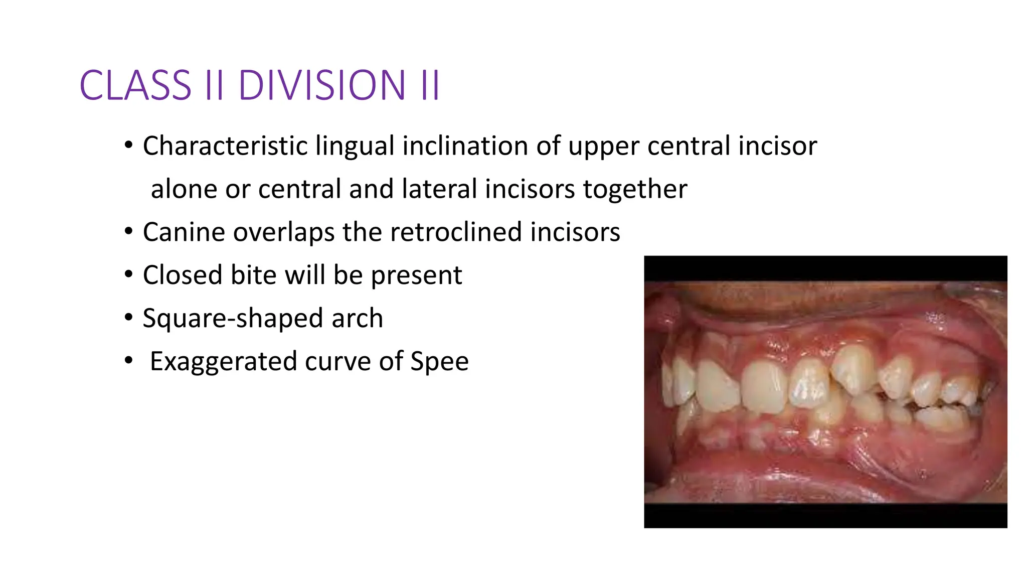 CLASS II DIVISION II
• Characteristic lingual inclination of upper central incisor
alone or central and lateral incisors together
• Canine overlaps the retroclined incisors
• Closed bite will be present
• Square-shaped arch
• Exaggerated curve of Spee
 