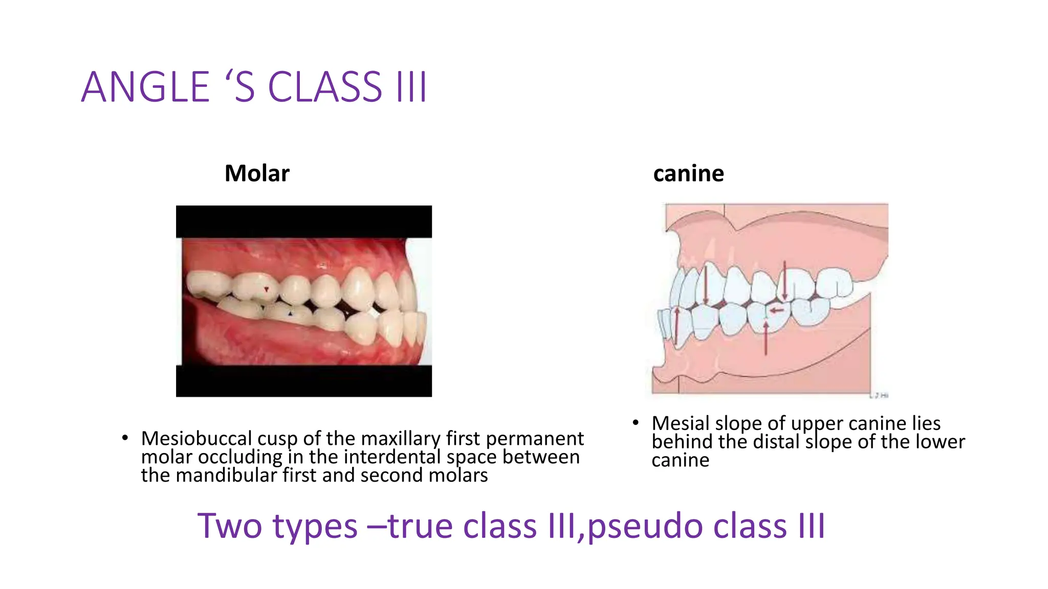 ANGLE ‘S CLASS III
Molar
• Mesiobuccal cusp of the maxillary first permanent
molar occluding in the interdental space between
the mandibular first and second molars
canine
• Mesial slope of upper canine lies
behind the distal slope of the lower
canine
Two types –true class III,pseudo class III
 