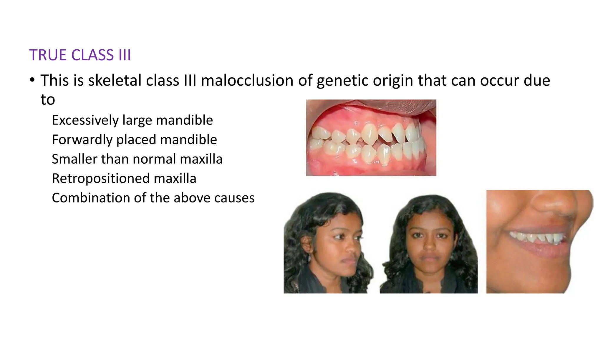 TRUE CLASS III
• This is skeletal class III malocclusion of genetic origin that can occur due
to
Excessively large mandible
Forwardly placed mandible
Smaller than normal maxilla
Retropositioned maxilla
Combination of the above causes
 