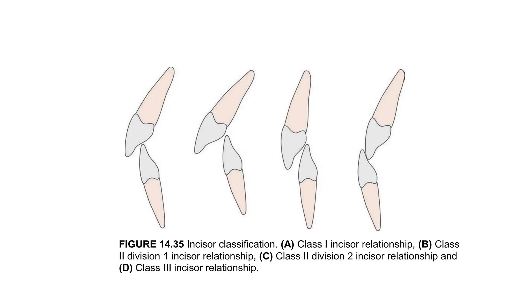 FIGURE 14.35 Incisor classification. (A) Class I incisor relationship, (B) Class
II division 1 incisor relationship, (C) Class II division 2 incisor relationship and
(D) Class III incisor relationship.
 