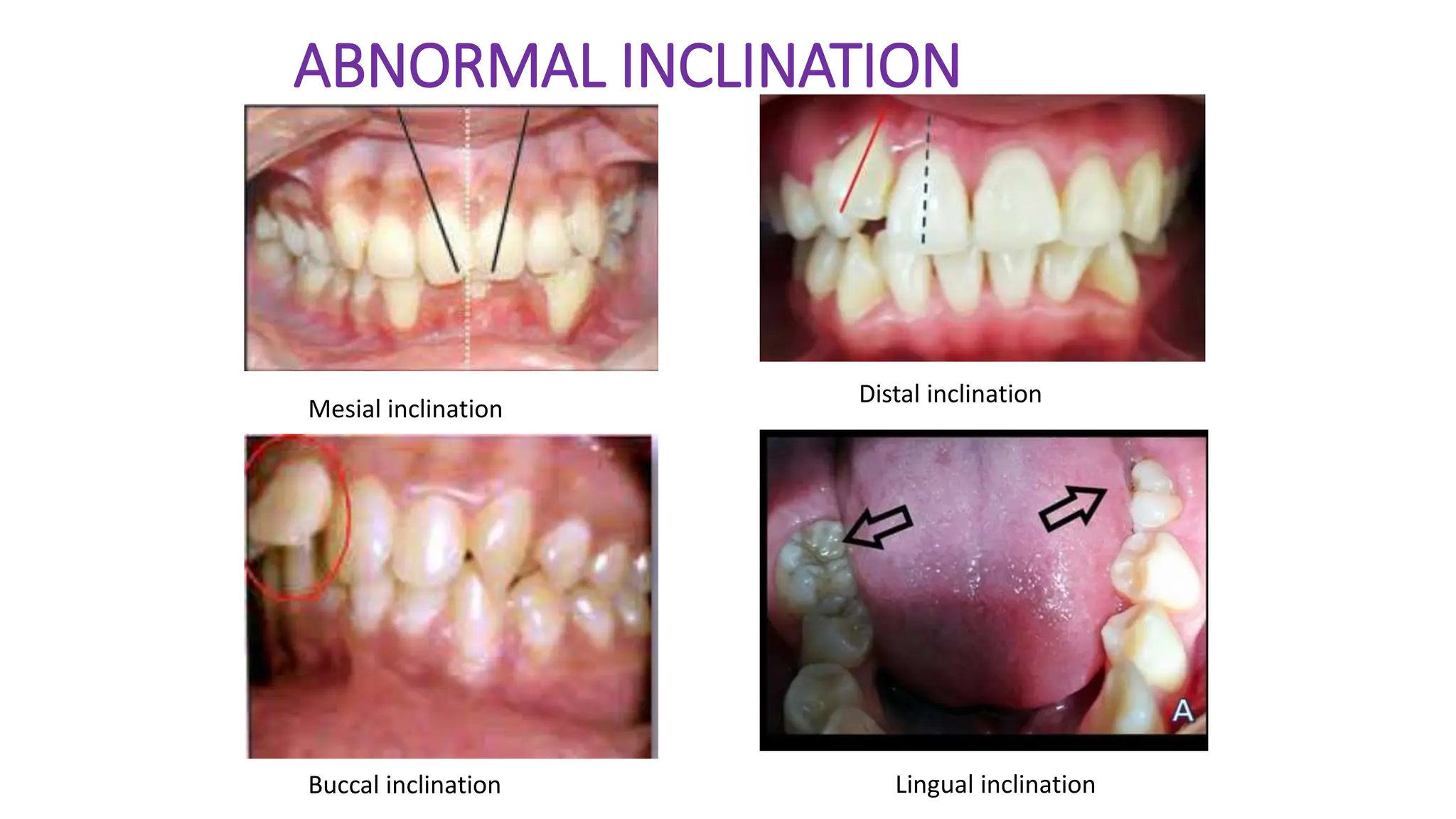 ABNORMAL INCLINATION
Mesial inclination
Distal inclination
Buccal inclination Lingual inclination
 