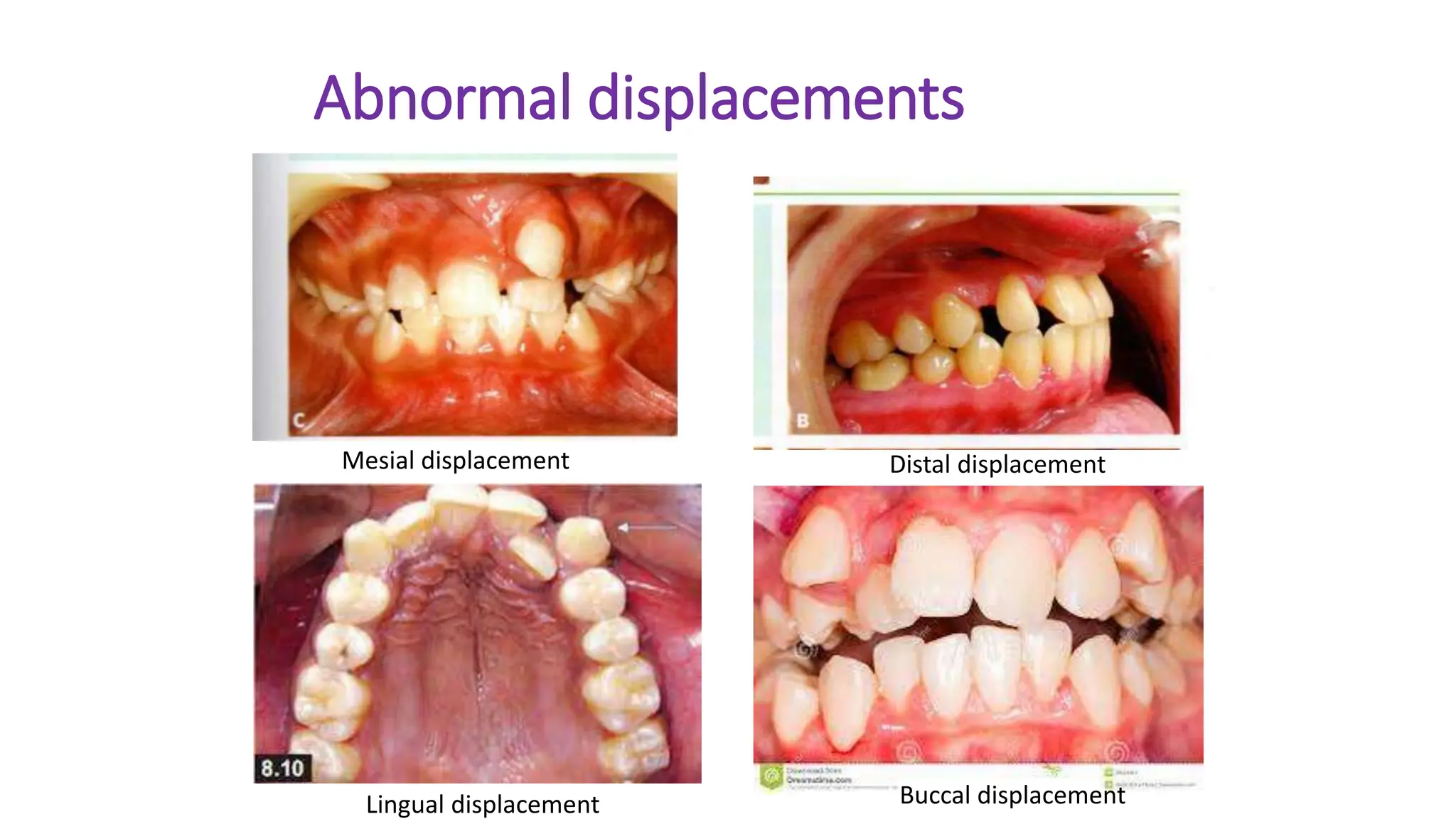 Abnormal displacements
Mesial displacement Distal displacement
Lingual displacement Buccal displacement
 