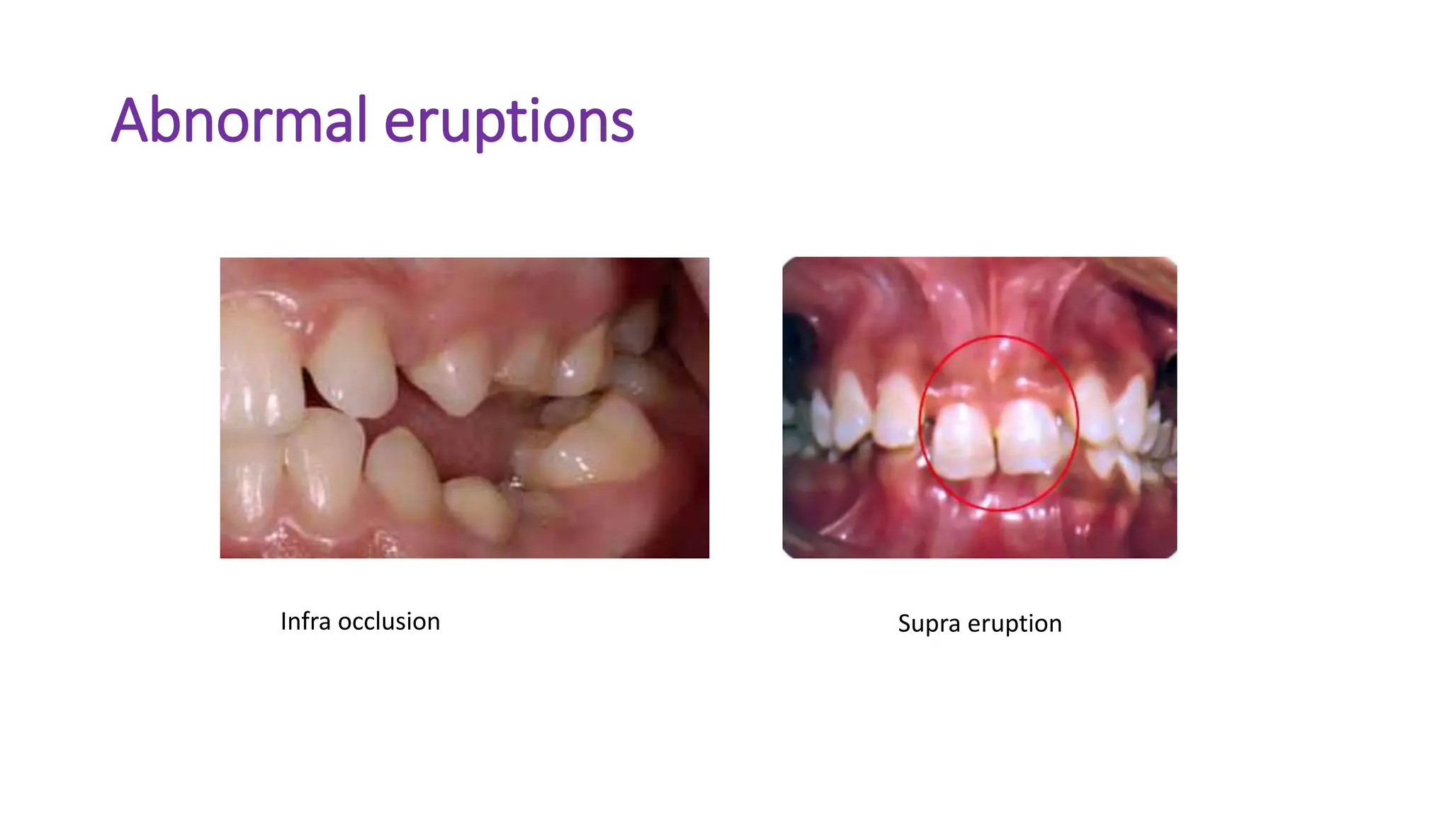 Abnormal eruptions
Infra occlusion Supra eruption
 