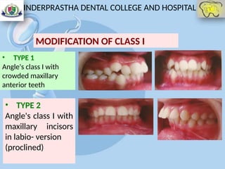 CLASSIFICATION OF Malocclusion skeletal and dental | PPTX