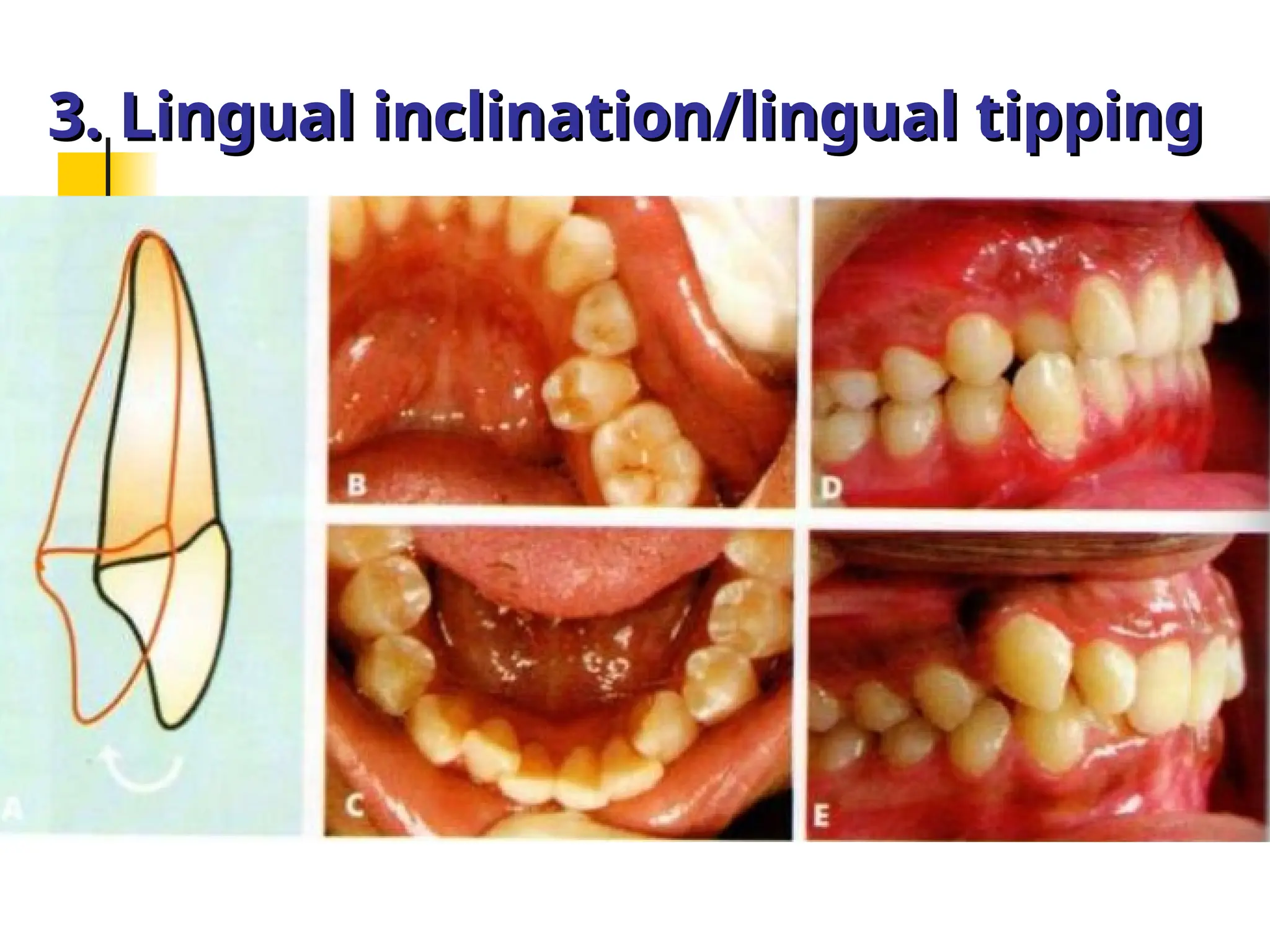 Inclination Classification of Malocclusion in orthodontics .ppt