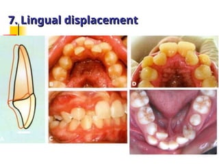 Classification of Malocclusion in orthodontics .ppt