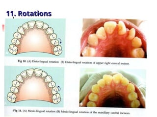 Classification of Malocclusion in orthodontics .ppt