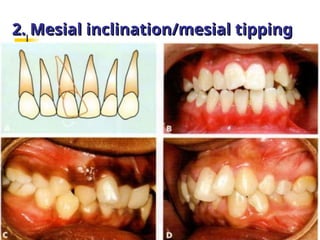 Mesial Rotation Classification of Malocclusion in orthodontics .ppt