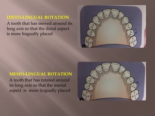 Mesial Rotation CLASSIFICATION OF MALOCCLUSION Orthodontics | PPTX