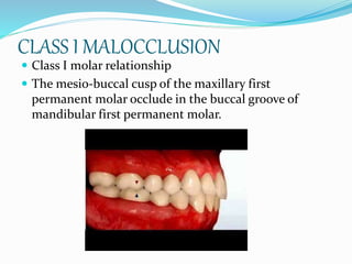 CLASS I MALOCCLUSION
 Class I molar relationship
 The mesio-buccal cusp of the maxillary first
permanent molar occlude in the buccal groove of
mandibular first permanent molar.
 