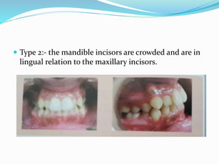  Type 2:- the mandible incisors are crowded and are in
lingual relation to the maxillary incisors.
 