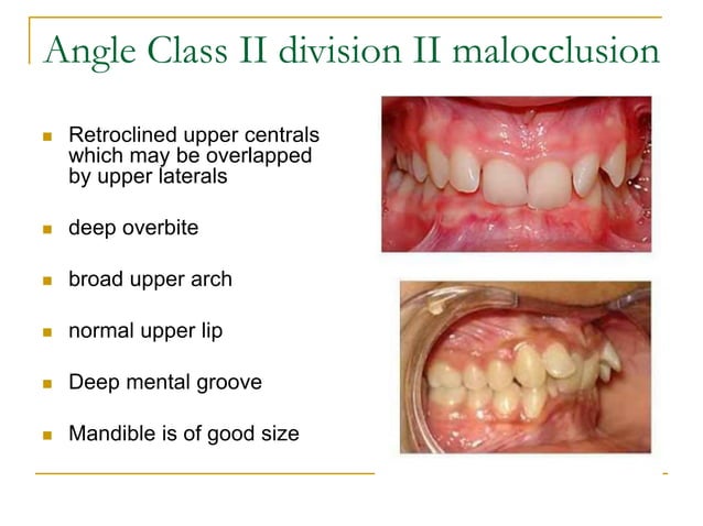 Classification of malocclusion-converted (1).pdf