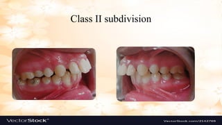 Classification of Malocclusion is a new presentation | PPTX