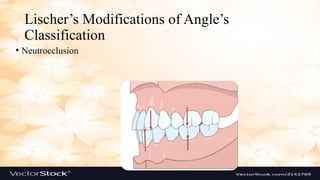 Classification of Malocclusion is a new presentation | PPTX