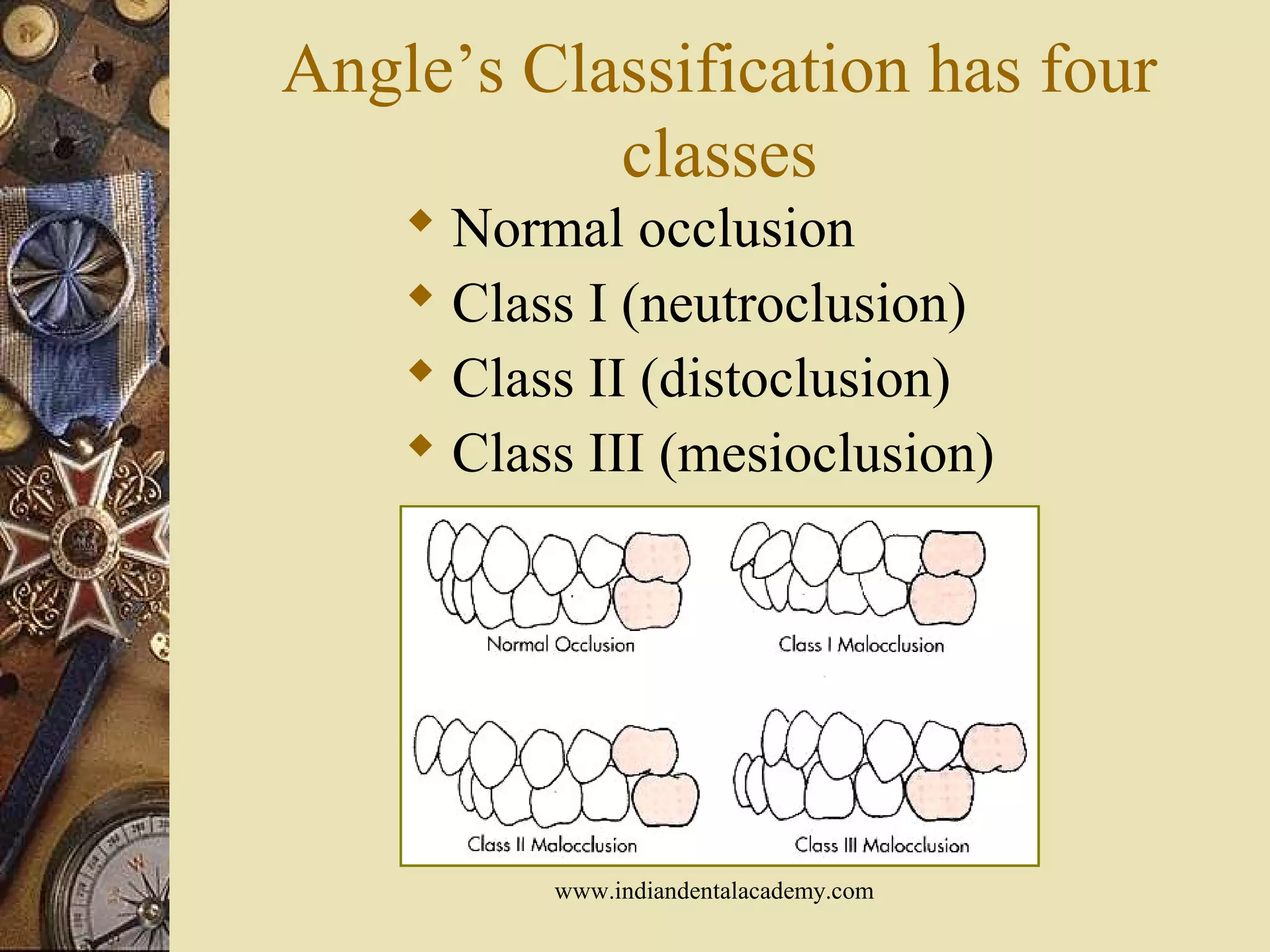Angle’s Classification has four
classes
 Normal occlusion
 Class I (neutroclusion)
 Class II (distoclusion)
 Class III (mesioclusion)
www.indiandentalacademy.com
 