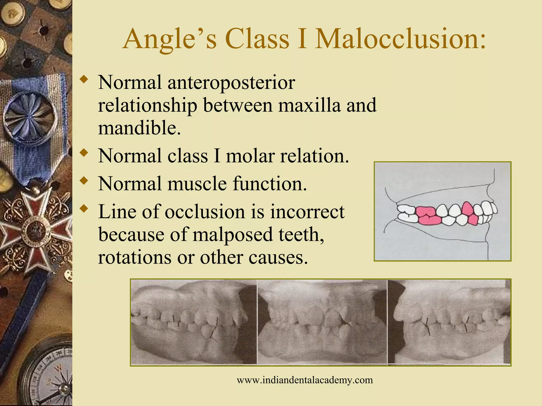 Angle’s Class I Malocclusion:
 Normal anteroposterior
relationship between maxilla and
mandible.
 Normal class I molar relation.
 Normal muscle function.
 Line of occlusion is incorrect
because of malposed teeth,
rotations or other causes.
www.indiandentalacademy.com
 