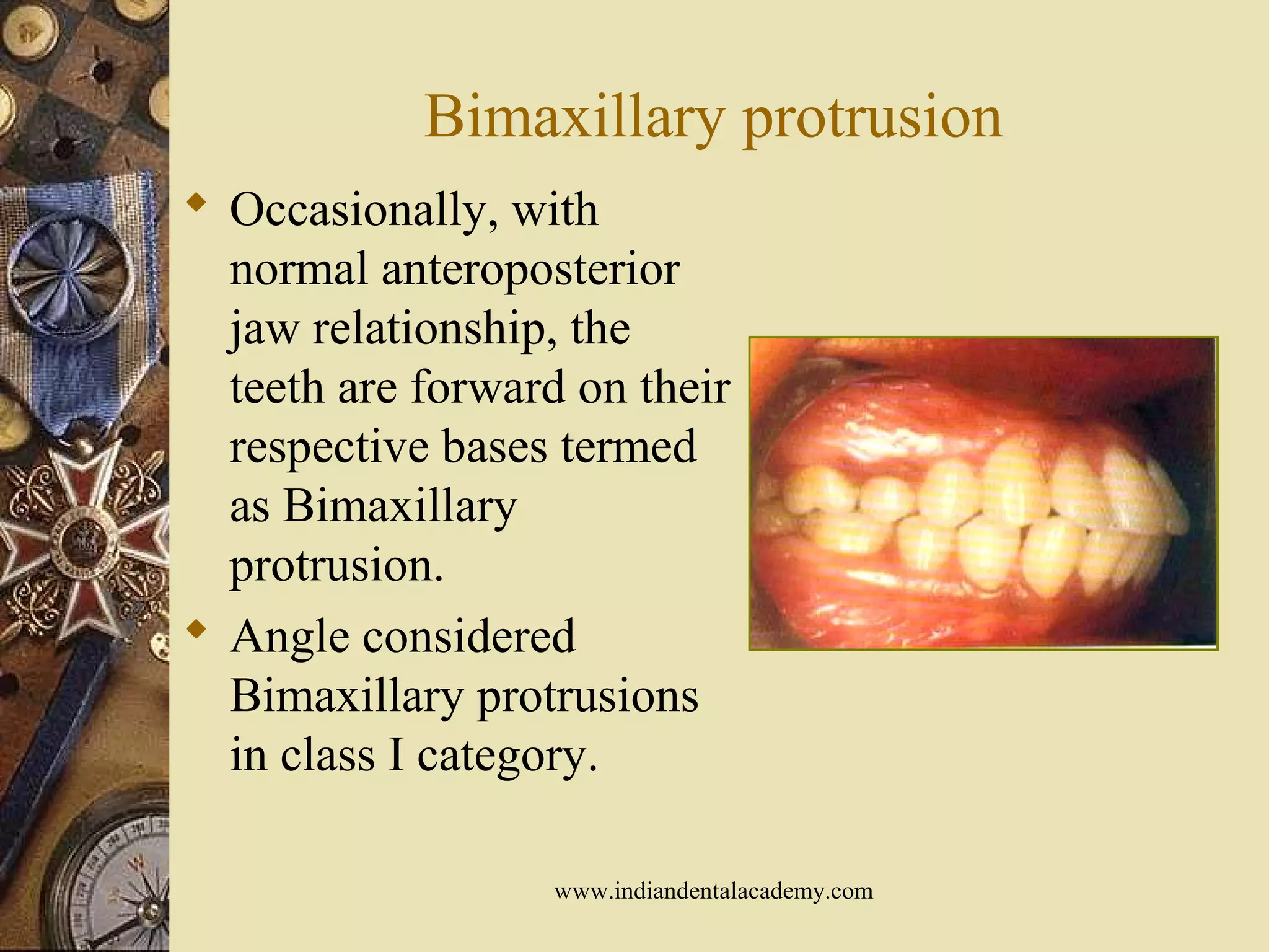 Bimaxillary protrusion
 Occasionally, with
normal anteroposterior
jaw relationship, the
teeth are forward on their
respective bases termed
as Bimaxillary
protrusion.
 Angle considered
Bimaxillary protrusions
in class I category.
www.indiandentalacademy.com
 