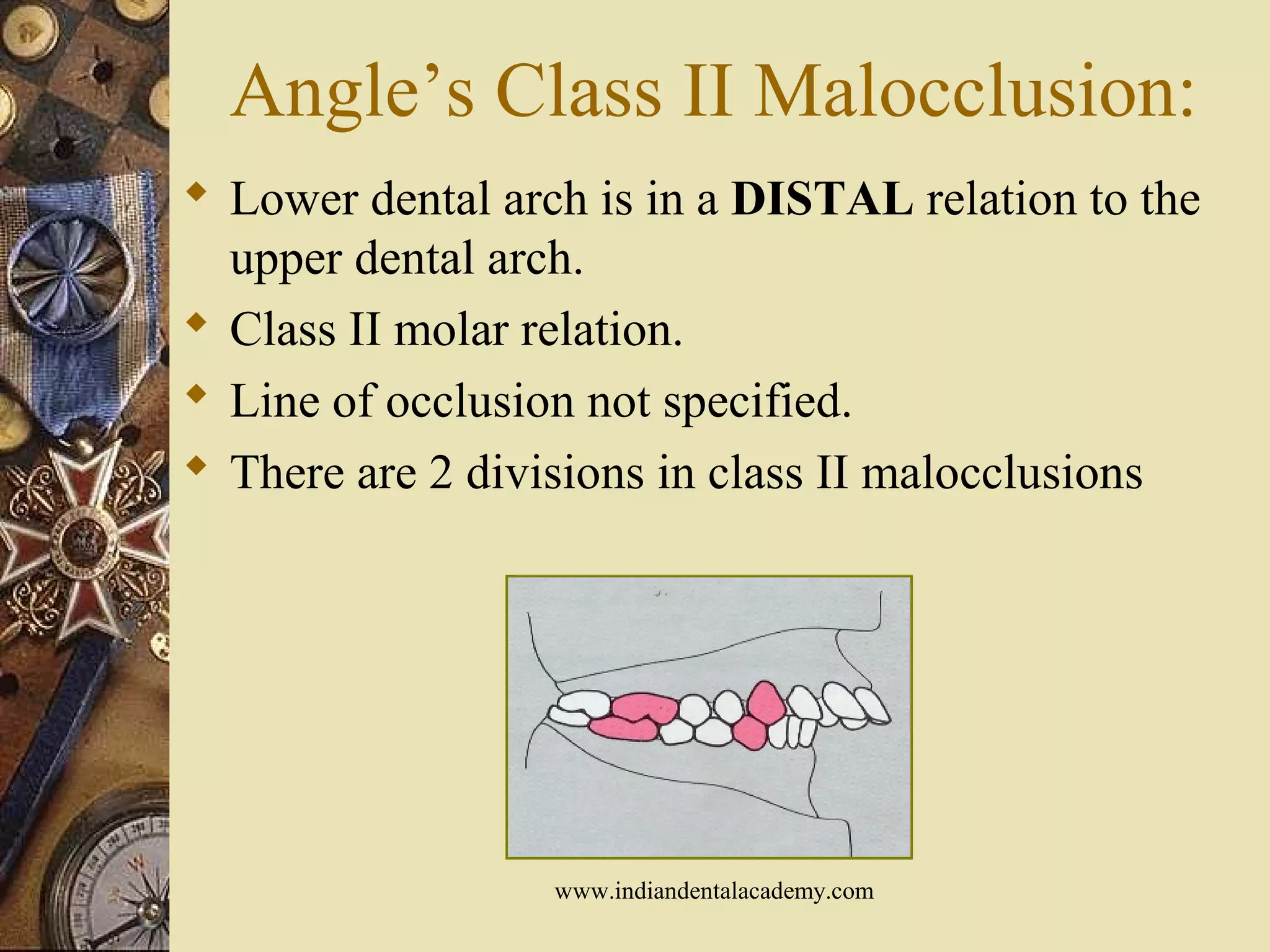 Angle’s Class II Malocclusion:
 Lower dental arch is in a DISTAL relation to the
upper dental arch.
 Class II molar relation.
 Line of occlusion not specified.
 There are 2 divisions in class II malocclusions
www.indiandentalacademy.com
 