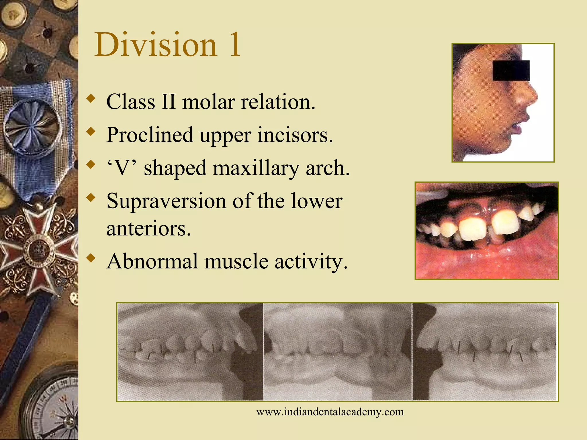 Division 1
 Class II molar relation.
 Proclined upper incisors.
 ‘V’ shaped maxillary arch.
 Supraversion of the lower
anteriors.
 Abnormal muscle activity.
www.indiandentalacademy.com
 