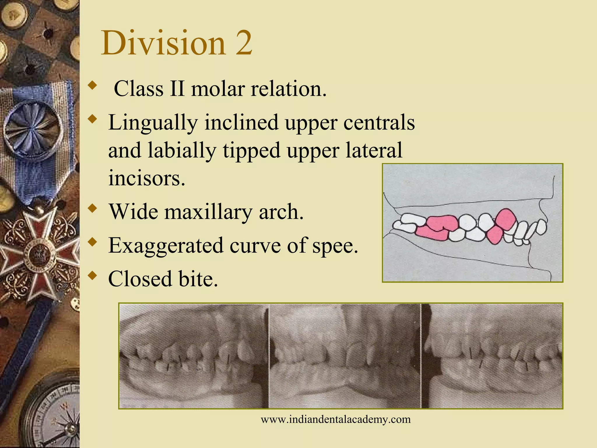 Division 2
 Class II molar relation.
 Lingually inclined upper centrals
and labially tipped upper lateral
incisors.
 Wide maxillary arch.
 Exaggerated curve of spee.
 Closed bite.
www.indiandentalacademy.com
 