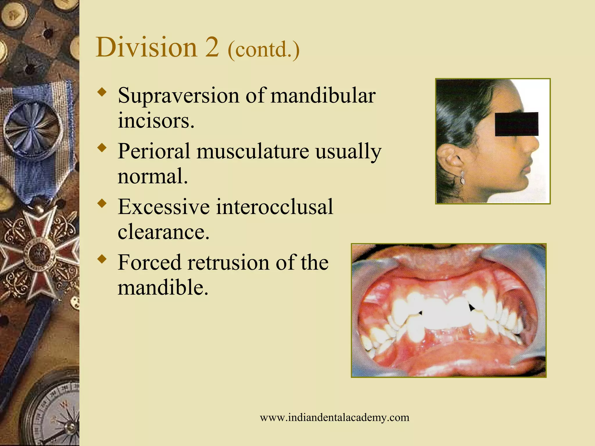 Division 2 (contd.)
 Supraversion of mandibular
incisors.
 Perioral musculature usually
normal.
 Excessive interocclusal
clearance.
 Forced retrusion of the
mandible.
www.indiandentalacademy.com
 