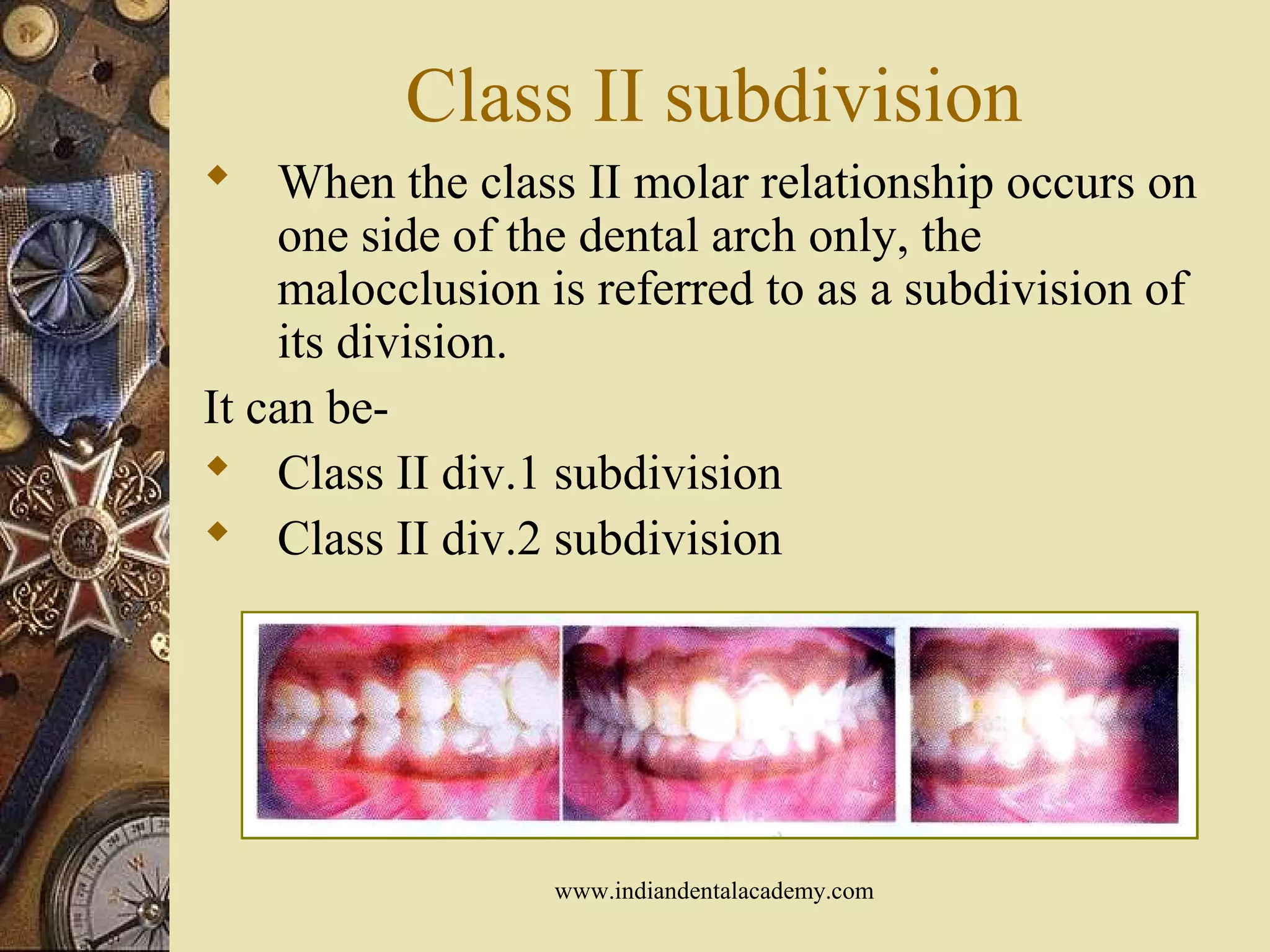 Class II subdivision
 When the class II molar relationship occurs on
one side of the dental arch only, the
malocclusion is referred to as a subdivision of
its division.
It can be-
 Class II div.1 subdivision
 Class II div.2 subdivision
www.indiandentalacademy.com
 