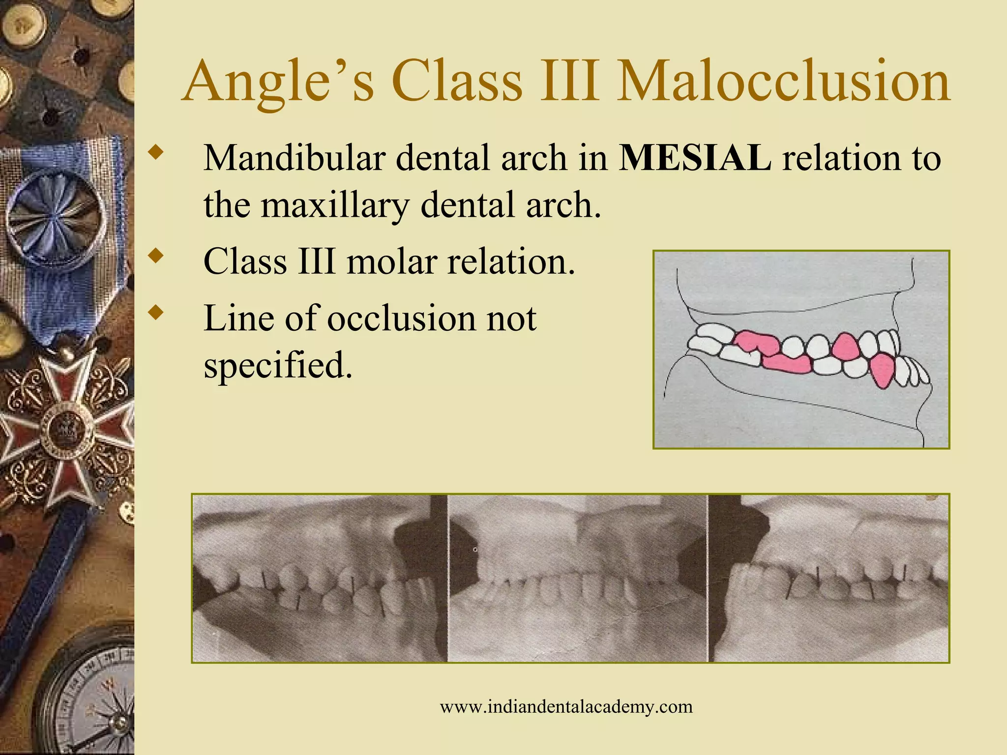 Angle’s Class III Malocclusion
 Mandibular dental arch in MESIAL relation to
the maxillary dental arch.
 Class III molar relation.
 Line of occlusion not
specified.
www.indiandentalacademy.com
 