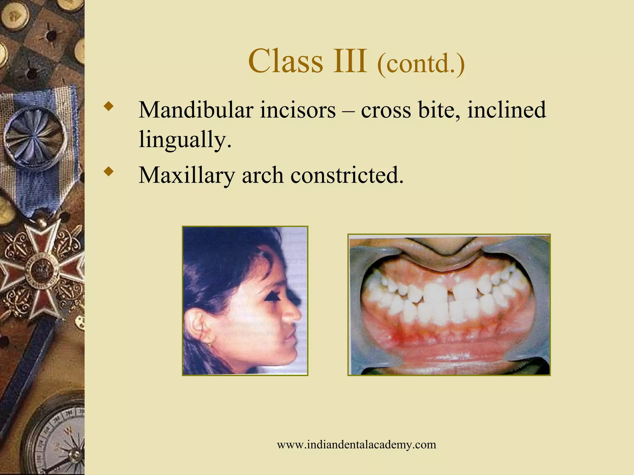 Class III (contd.)
 Mandibular incisors – cross bite, inclined
lingually.
 Maxillary arch constricted.
www.indiandentalacademy.com
 