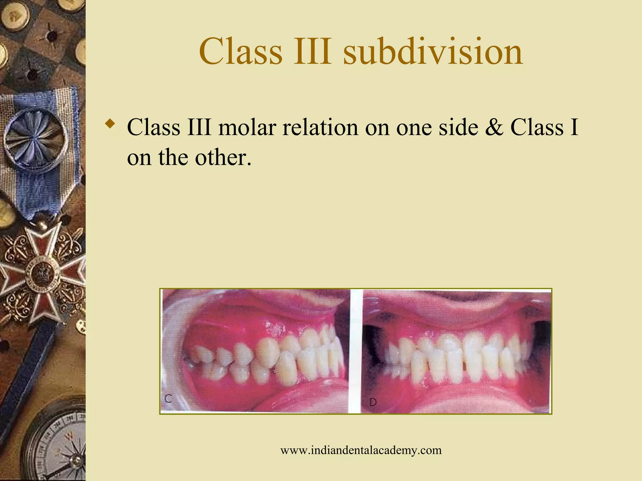 Class III subdivision
 Class III molar relation on one side & Class I
on the other.
www.indiandentalacademy.com
 