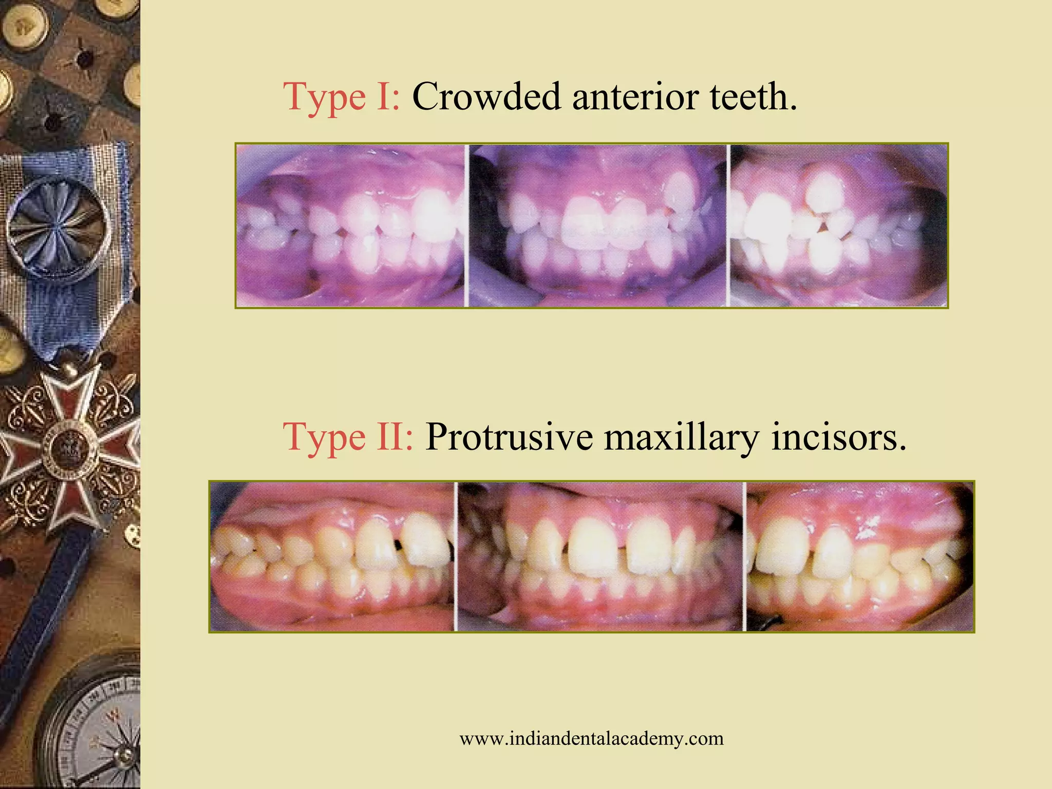 Type I: Crowded anterior teeth.
Type II: Protrusive maxillary incisors.
www.indiandentalacademy.com
 