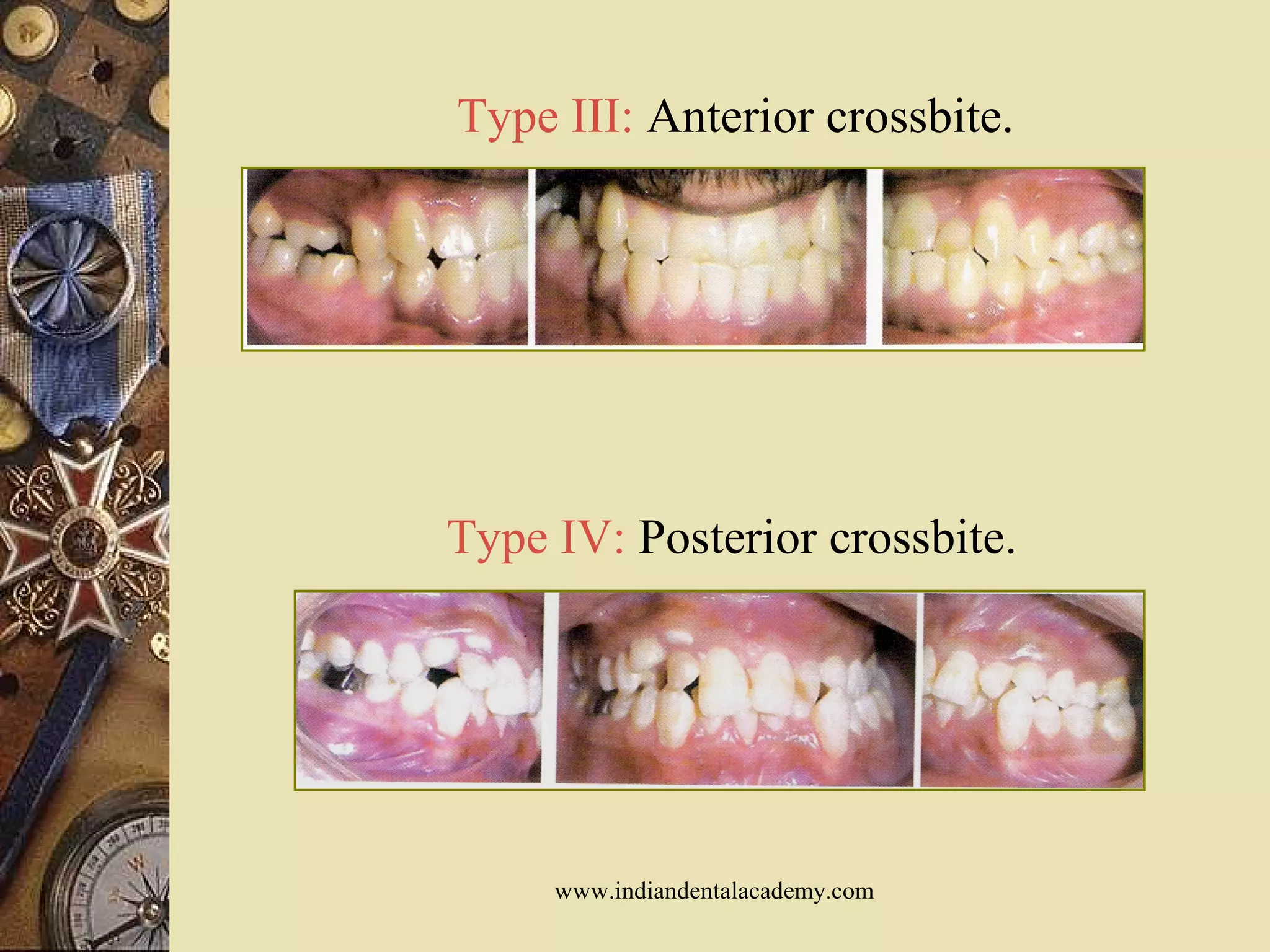 Type III: Anterior crossbite.
Type IV: Posterior crossbite.
www.indiandentalacademy.com
 