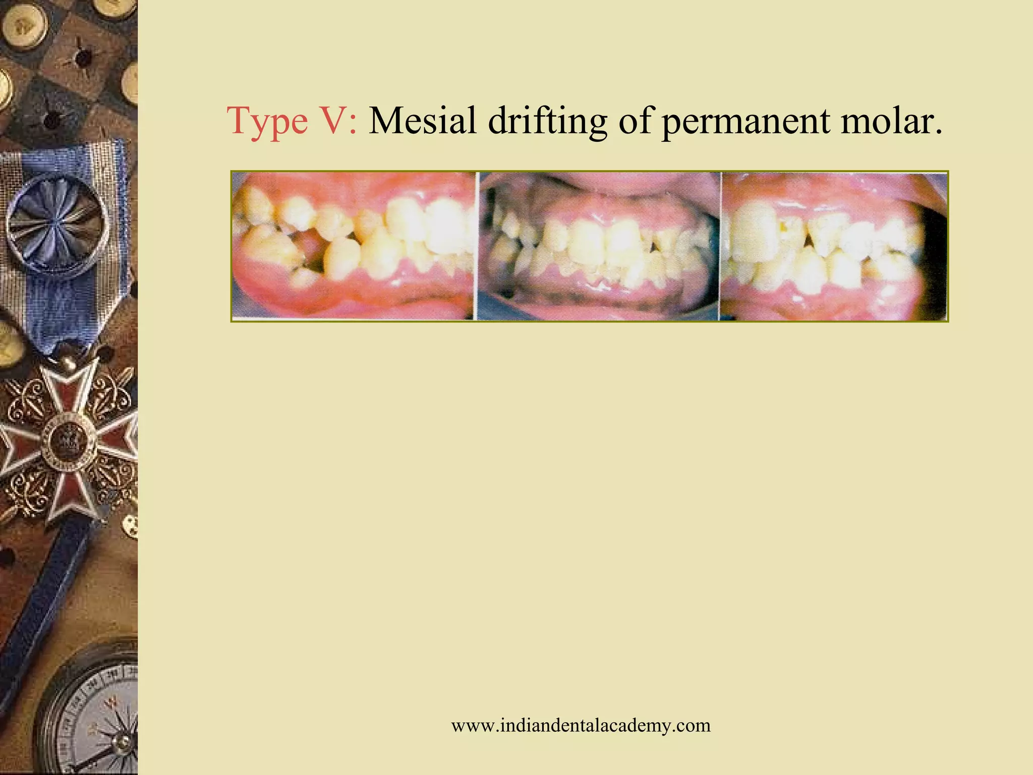 Type V: Mesial drifting of permanent molar.
www.indiandentalacademy.com
 