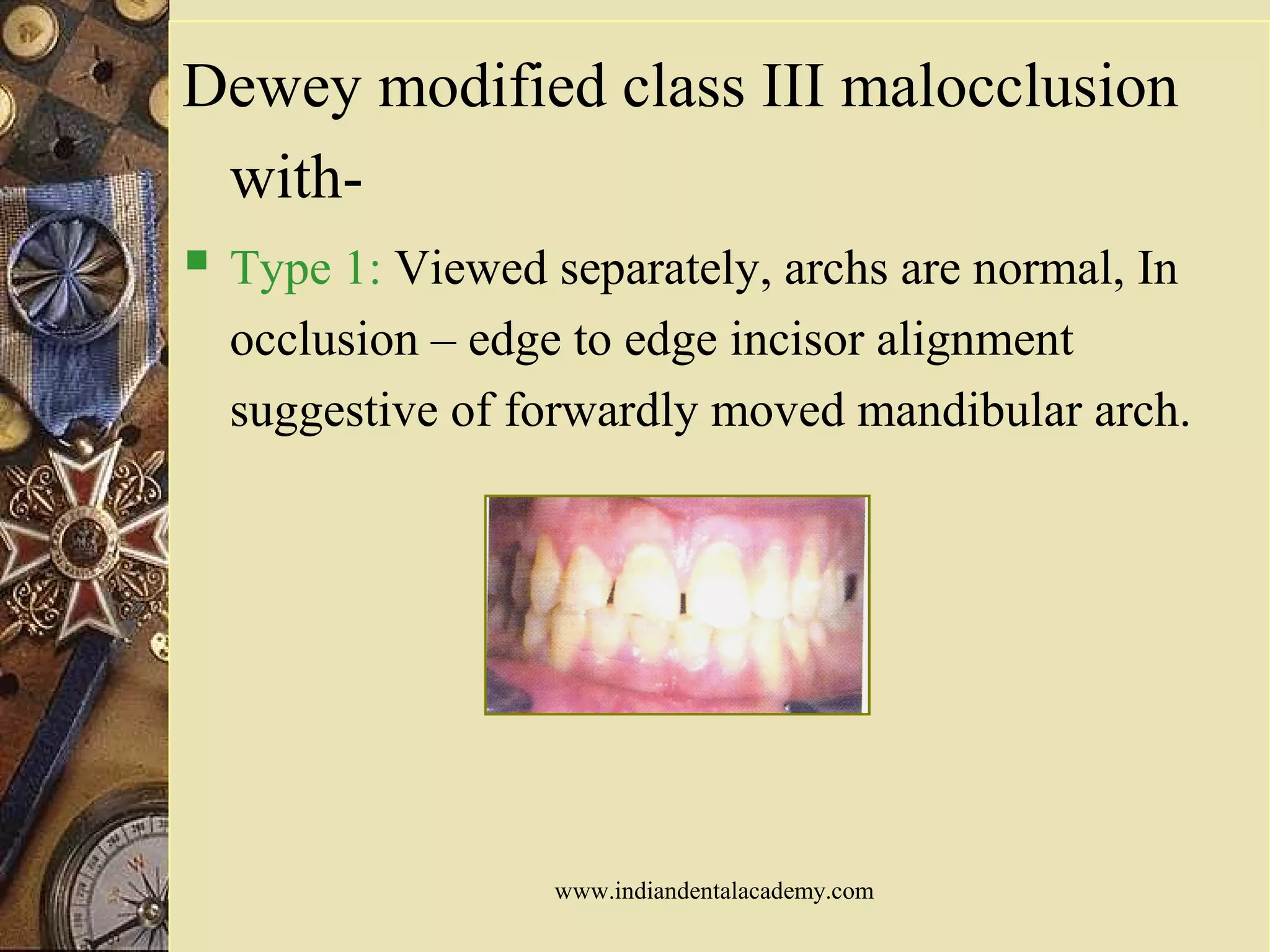 Dewey modified class III malocclusion
with-
 Type 1: Viewed separately, archs are normal, In
occlusion – edge to edge incisor alignment
suggestive of forwardly moved mandibular arch.
www.indiandentalacademy.com
 