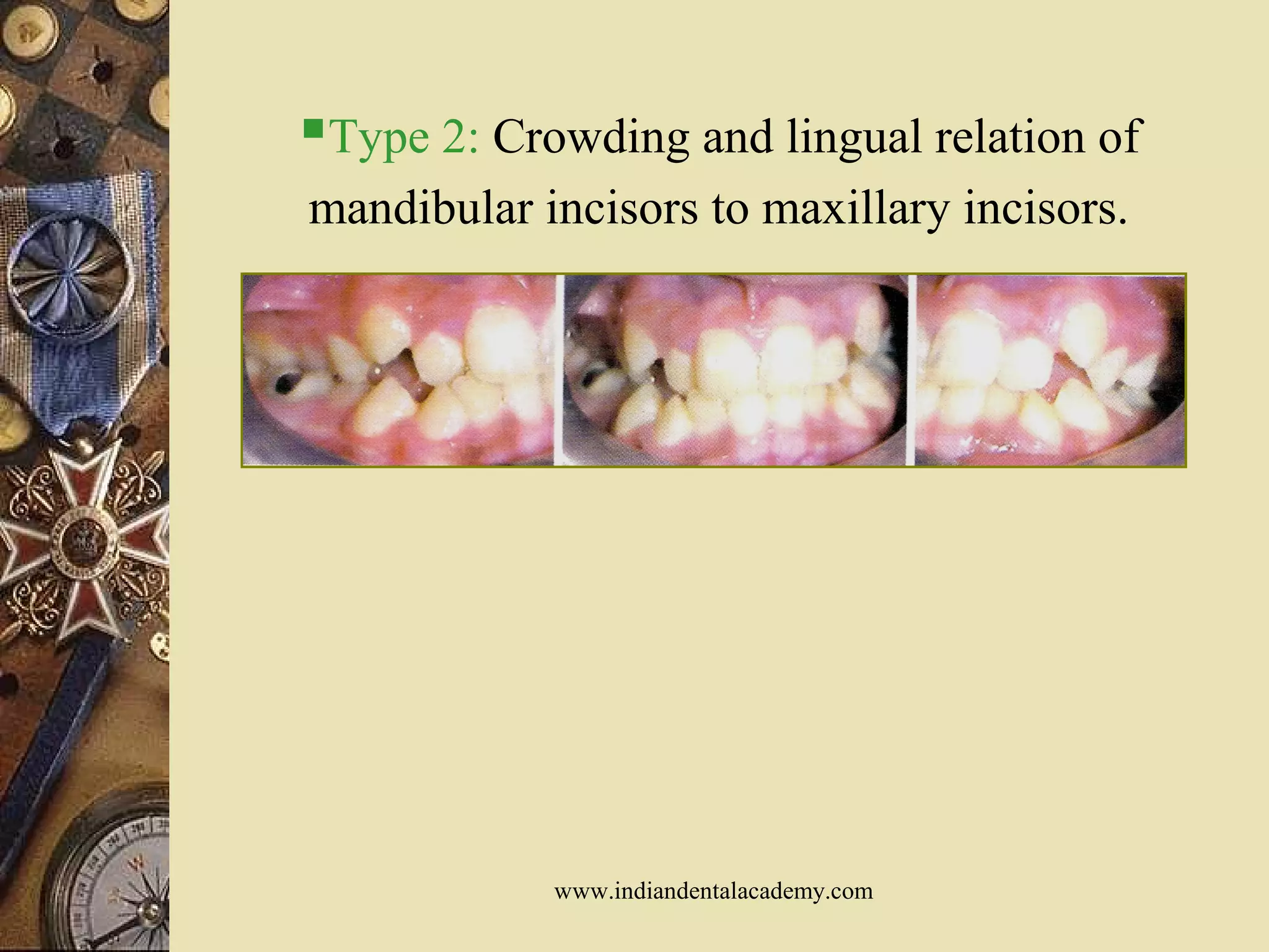 Type 2: Crowding and lingual relation of
mandibular incisors to maxillary incisors.
www.indiandentalacademy.com
 