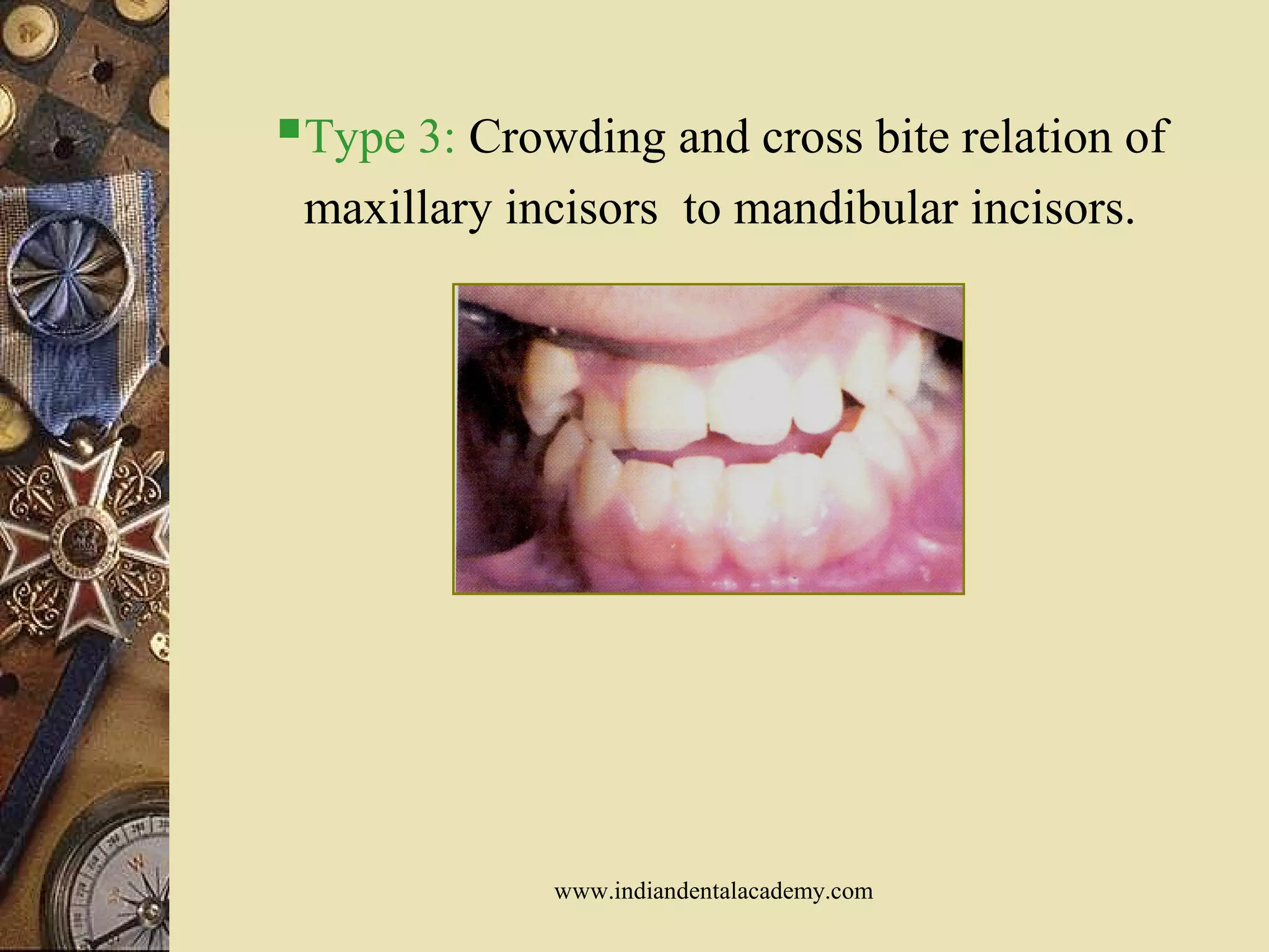 Type 3: Crowding and cross bite relation of
maxillary incisors to mandibular incisors.
www.indiandentalacademy.com
 