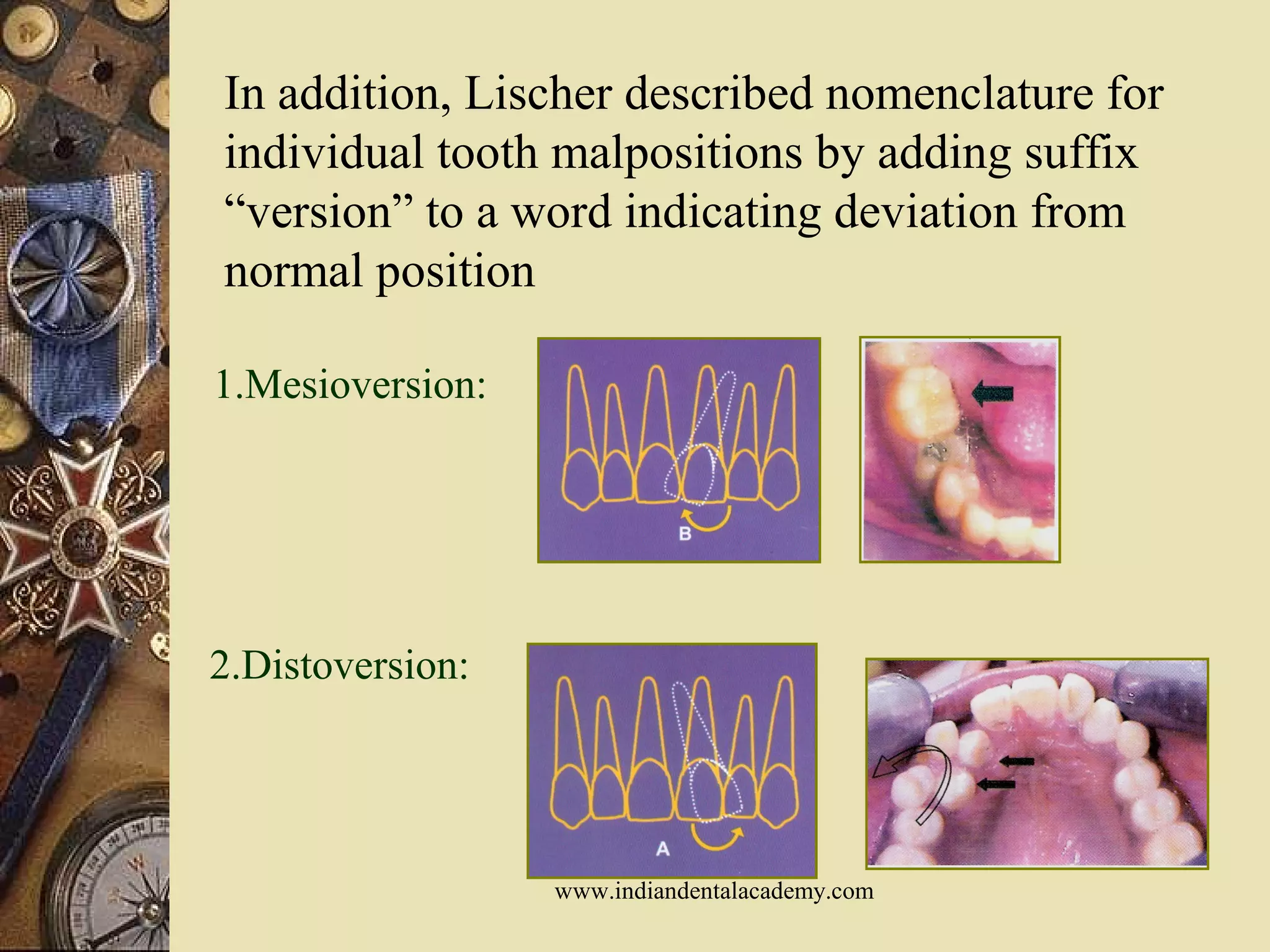 In addition, Lischer described nomenclature for
individual tooth malpositions by adding suffix
“version” to a word indicating deviation from
normal position
1.Mesioversion:
2.Distoversion:
www.indiandentalacademy.com
 