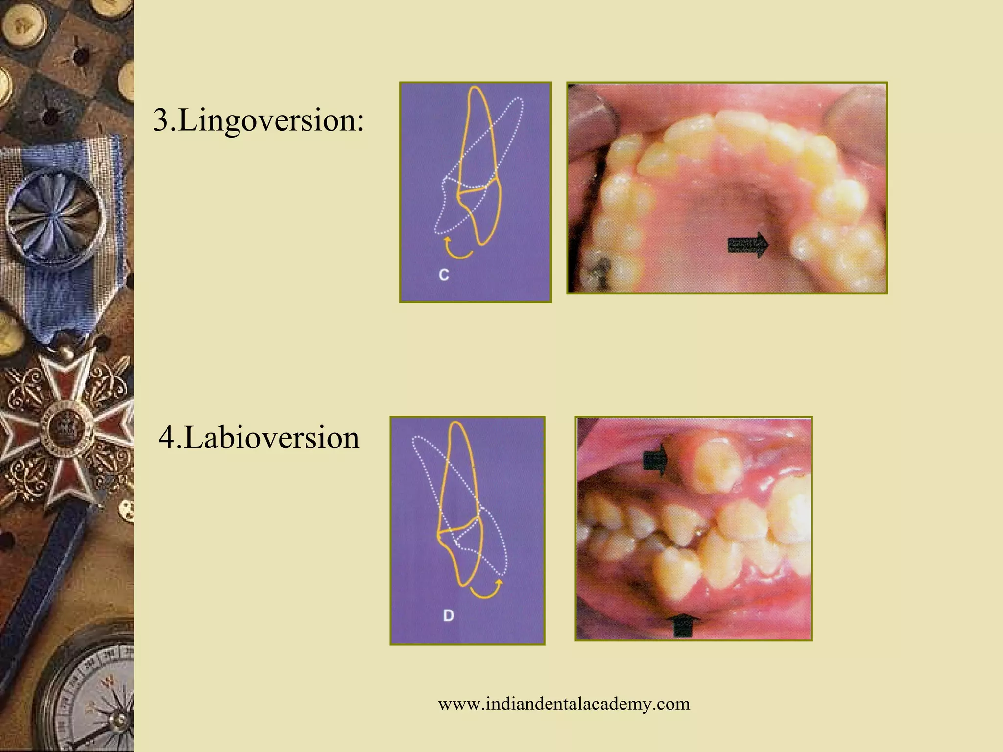 3.Lingoversion:
4.Labioversion
www.indiandentalacademy.com
 