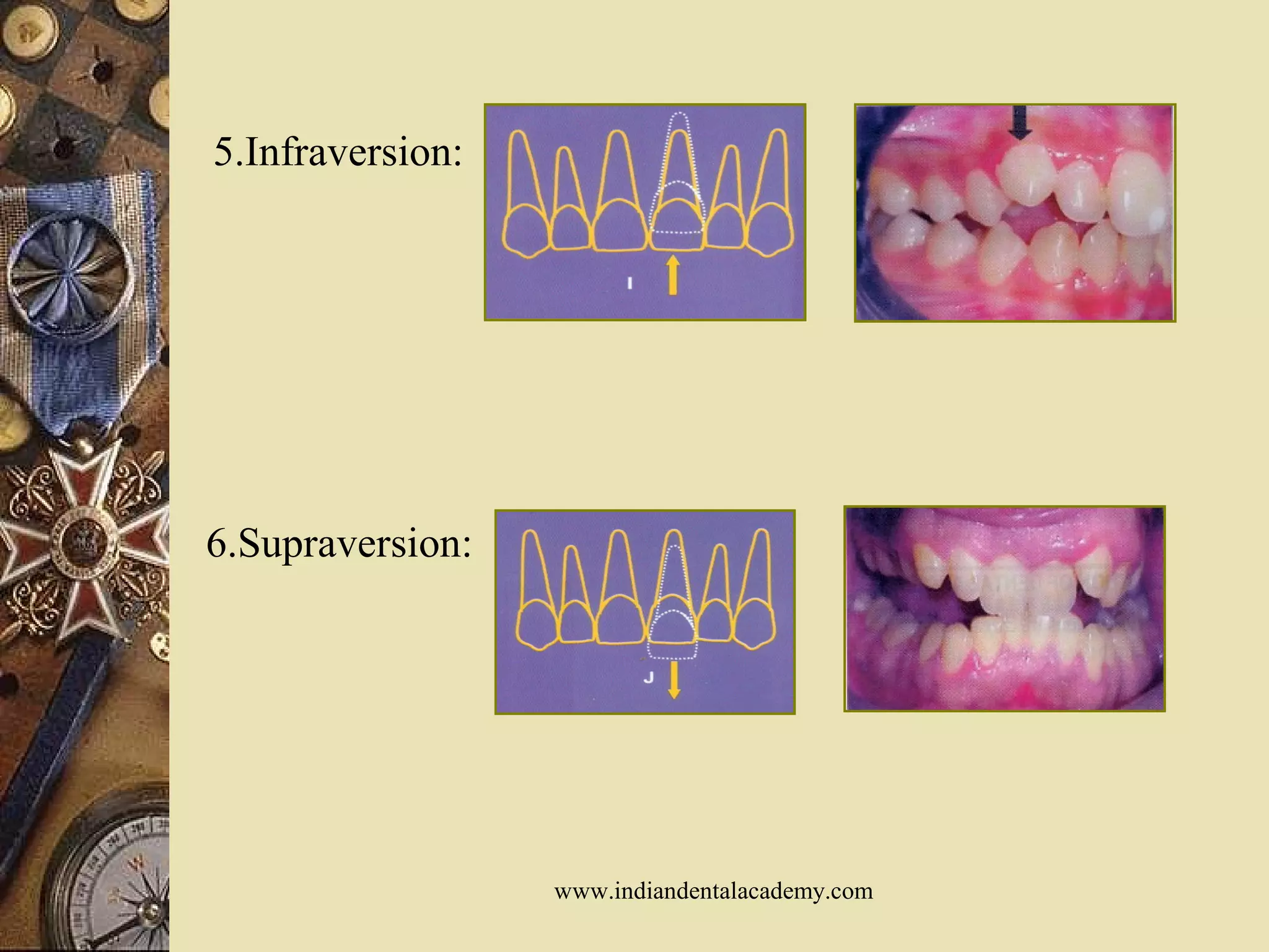 5.Infraversion:
6.Supraversion:
www.indiandentalacademy.com
 