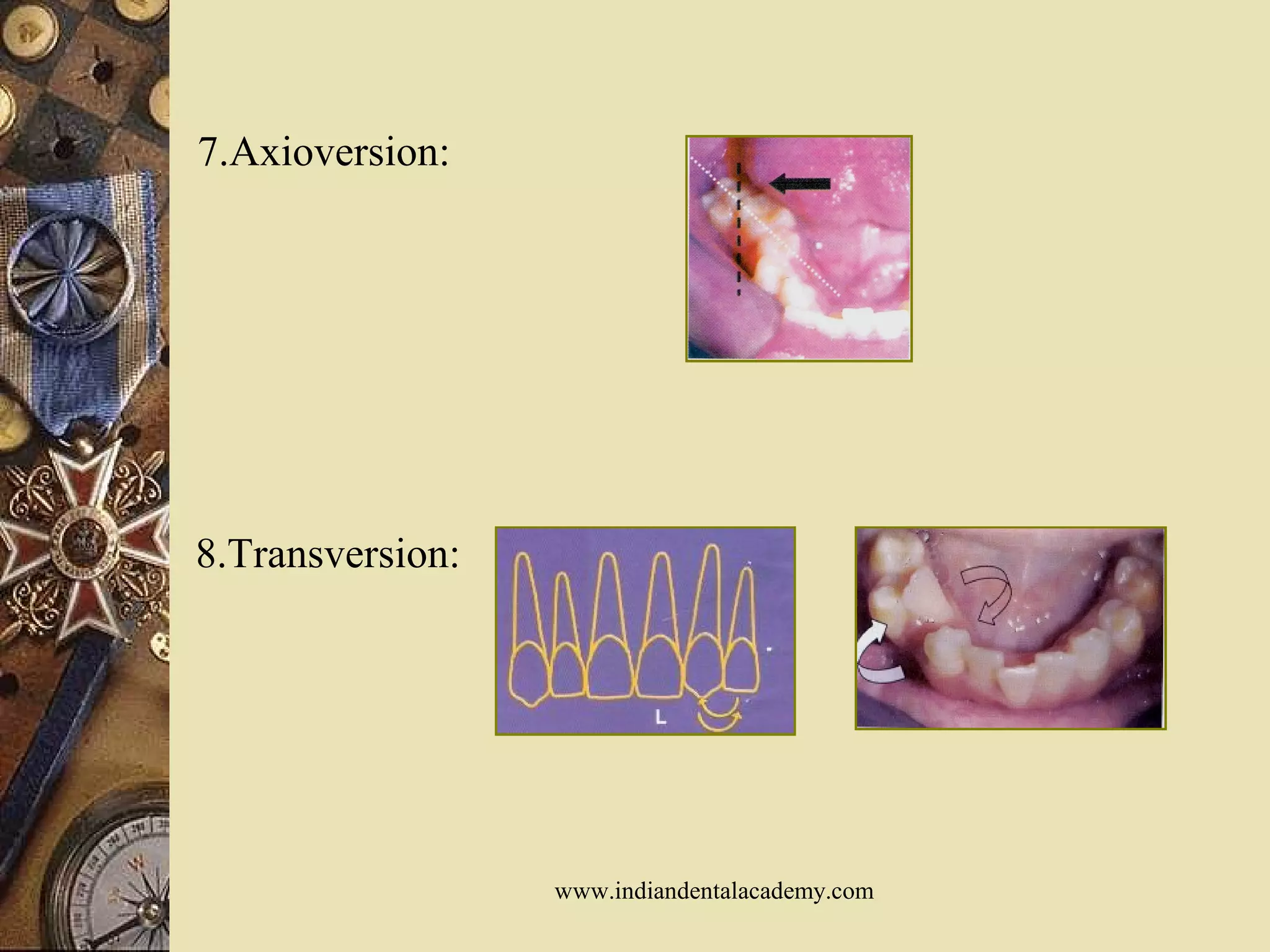 7.Axioversion:
8.Transversion:
www.indiandentalacademy.com
 