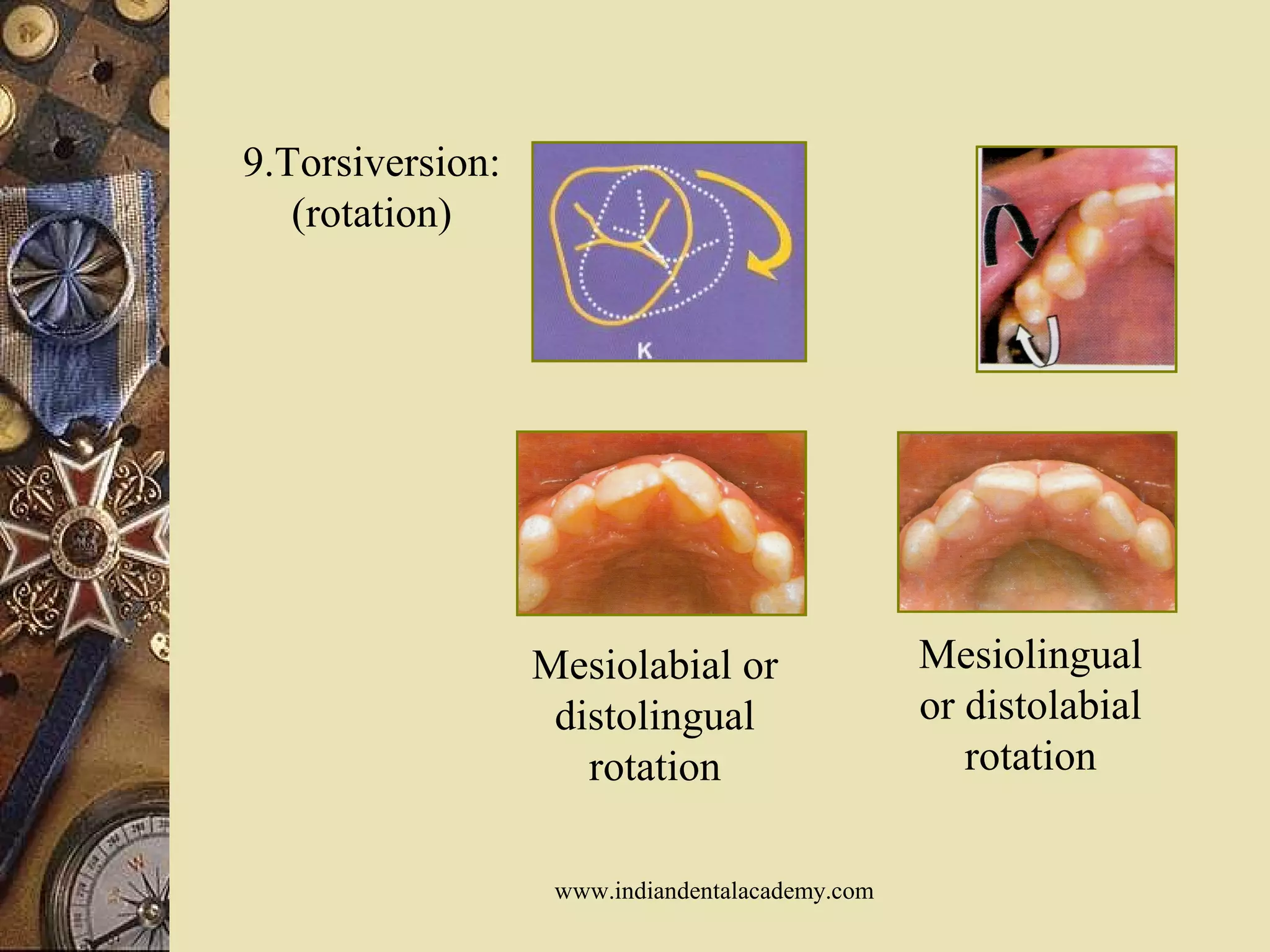 9.Torsiversion:
(rotation)
Mesiolingual
or distolabial
rotation
Mesiolabial or
distolingual
rotation
www.indiandentalacademy.com
 