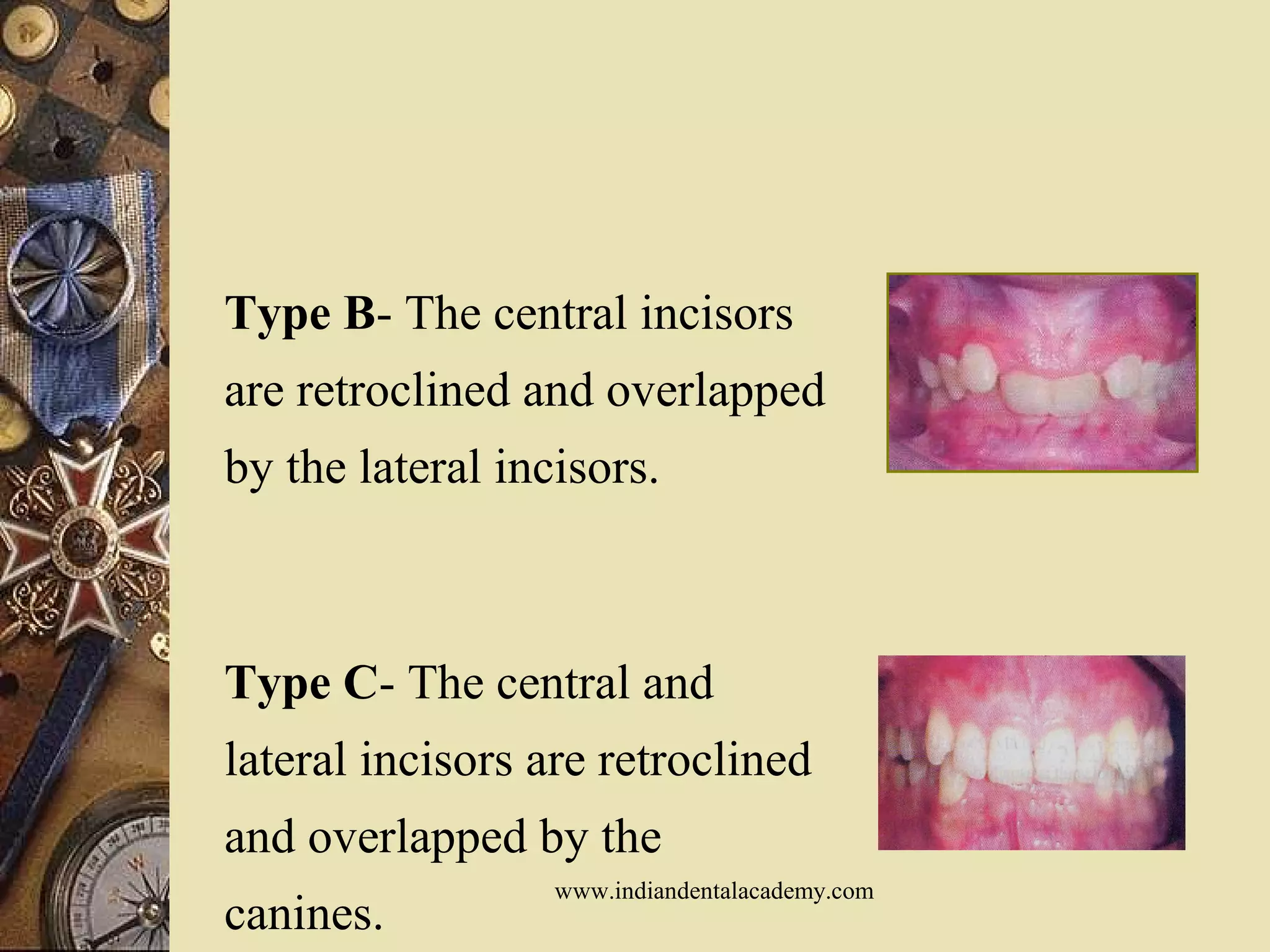 Type B- The central incisors
are retroclined and overlapped
by the lateral incisors.
Type C- The central and
lateral incisors are retroclined
and overlapped by the
canines.
www.indiandentalacademy.com
 
