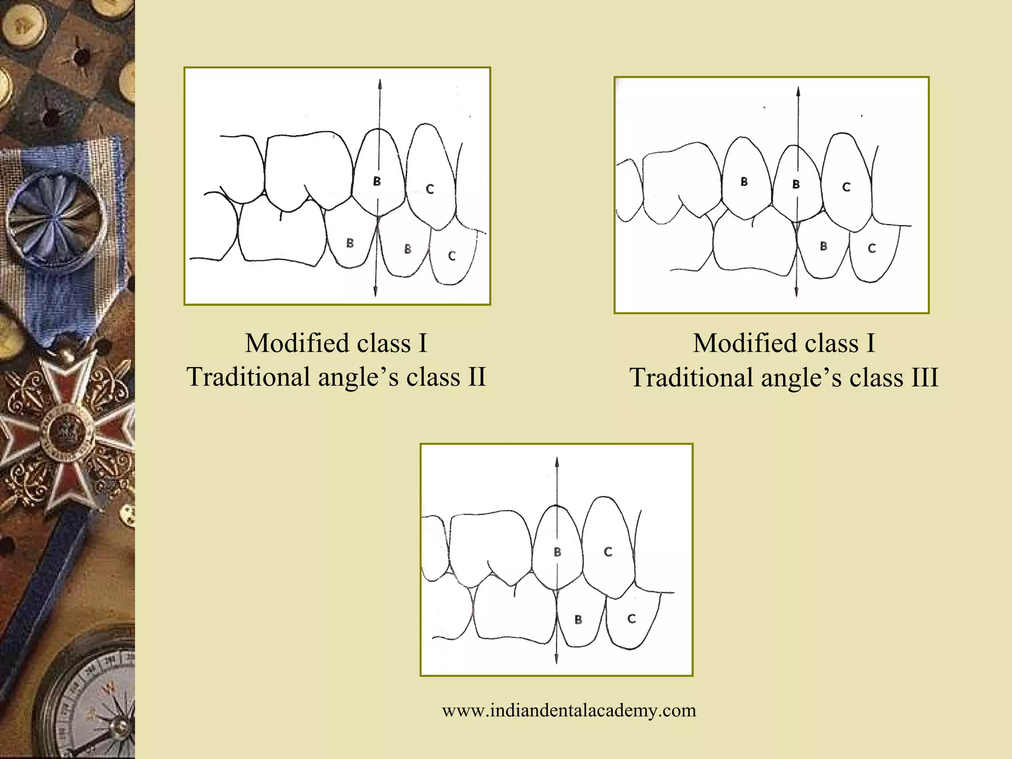 Modified class I
Traditional angle’s class II
Modified class I
Traditional angle’s class III
www.indiandentalacademy.com
 
