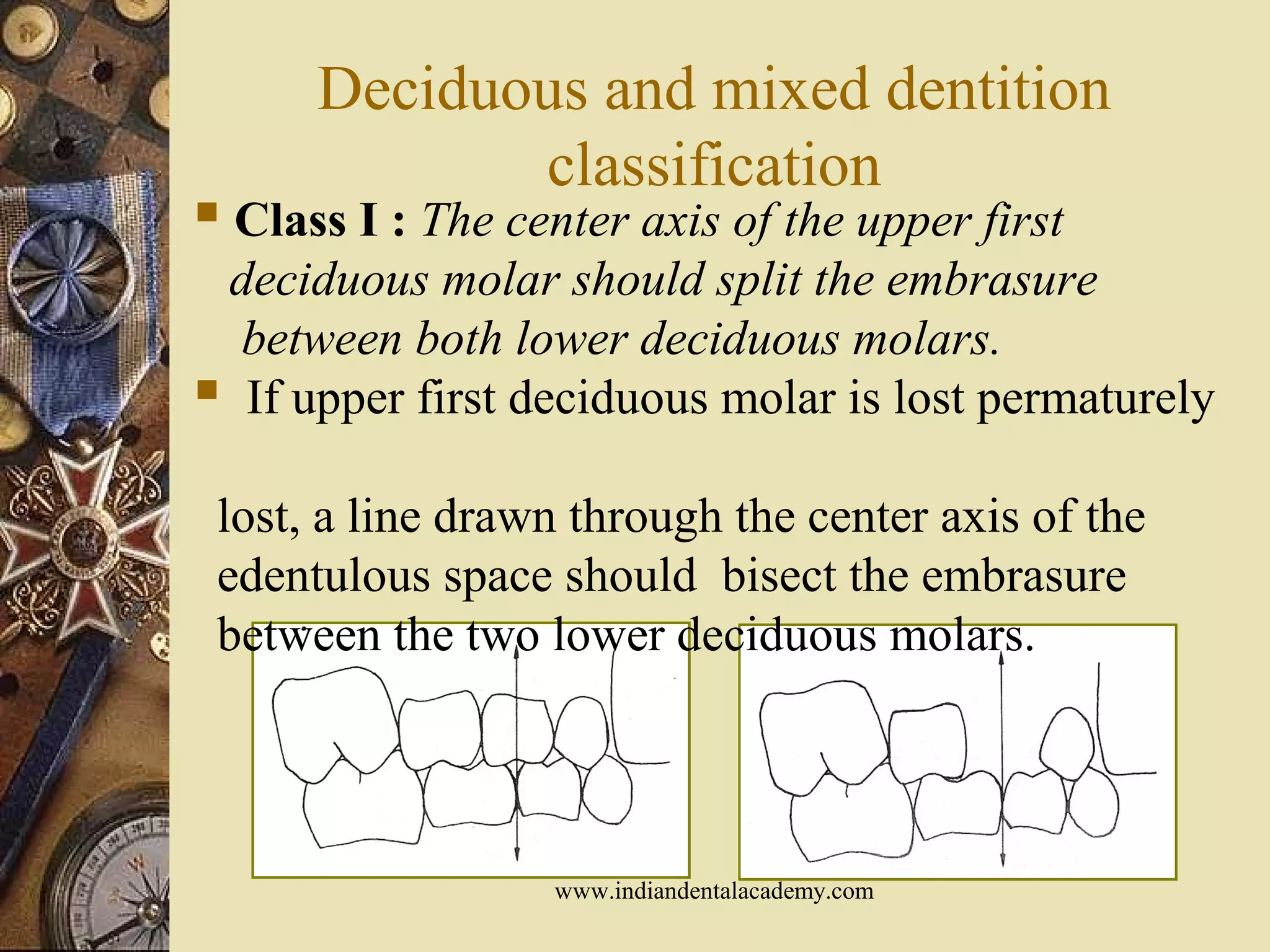 Deciduous and mixed dentition
classification
 Class I : The center axis of the upper first
deciduous molar should split the embrasure
between both lower deciduous molars.
 If upper first deciduous molar is lost permaturely
lost, a line drawn through the center axis of the
edentulous space should bisect the embrasure
between the two lower deciduous molars.
www.indiandentalacademy.com
 